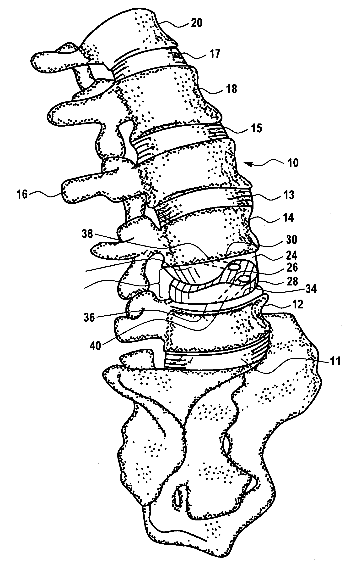 Artificial prosthesis