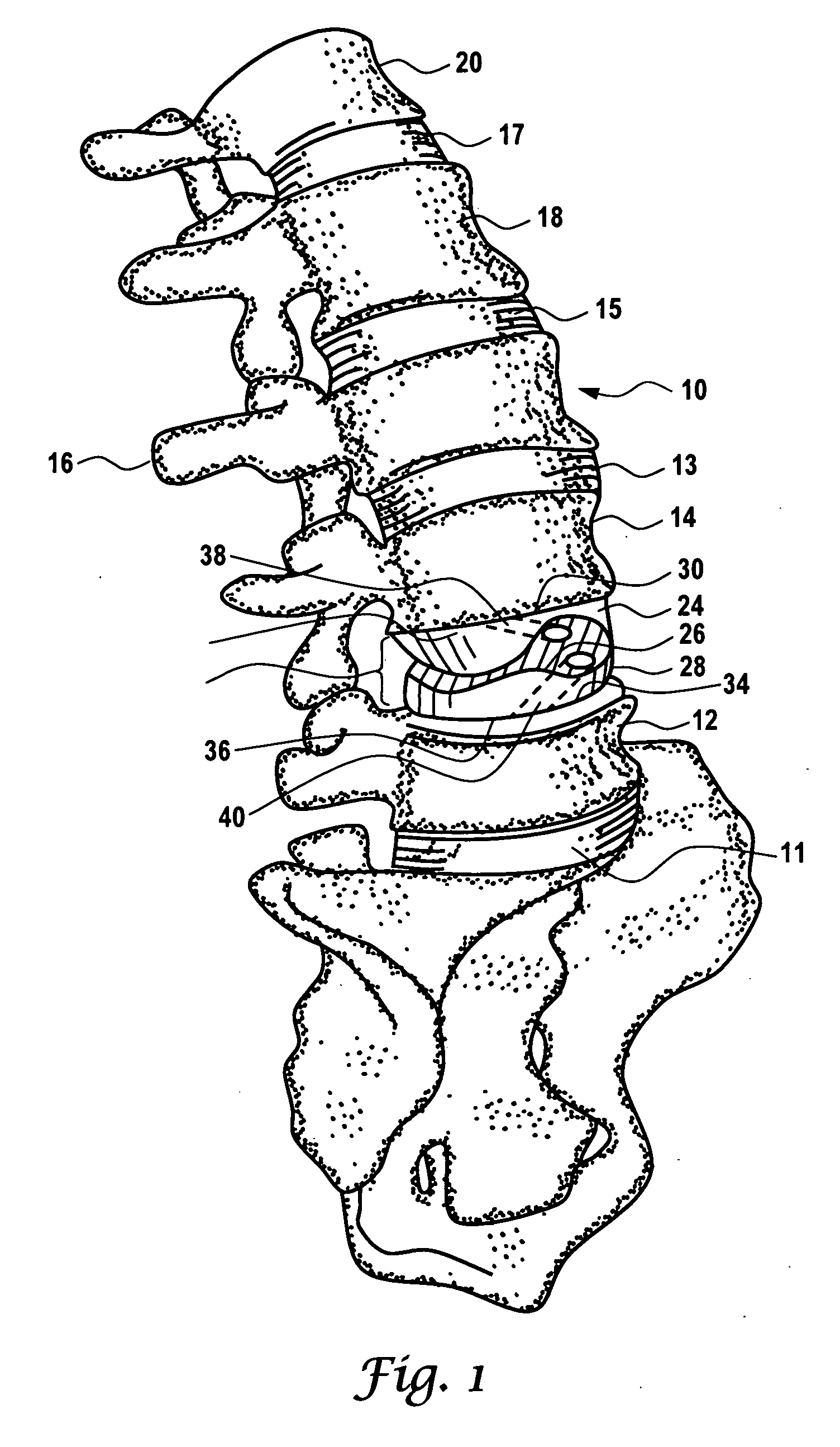 Artificial prosthesis