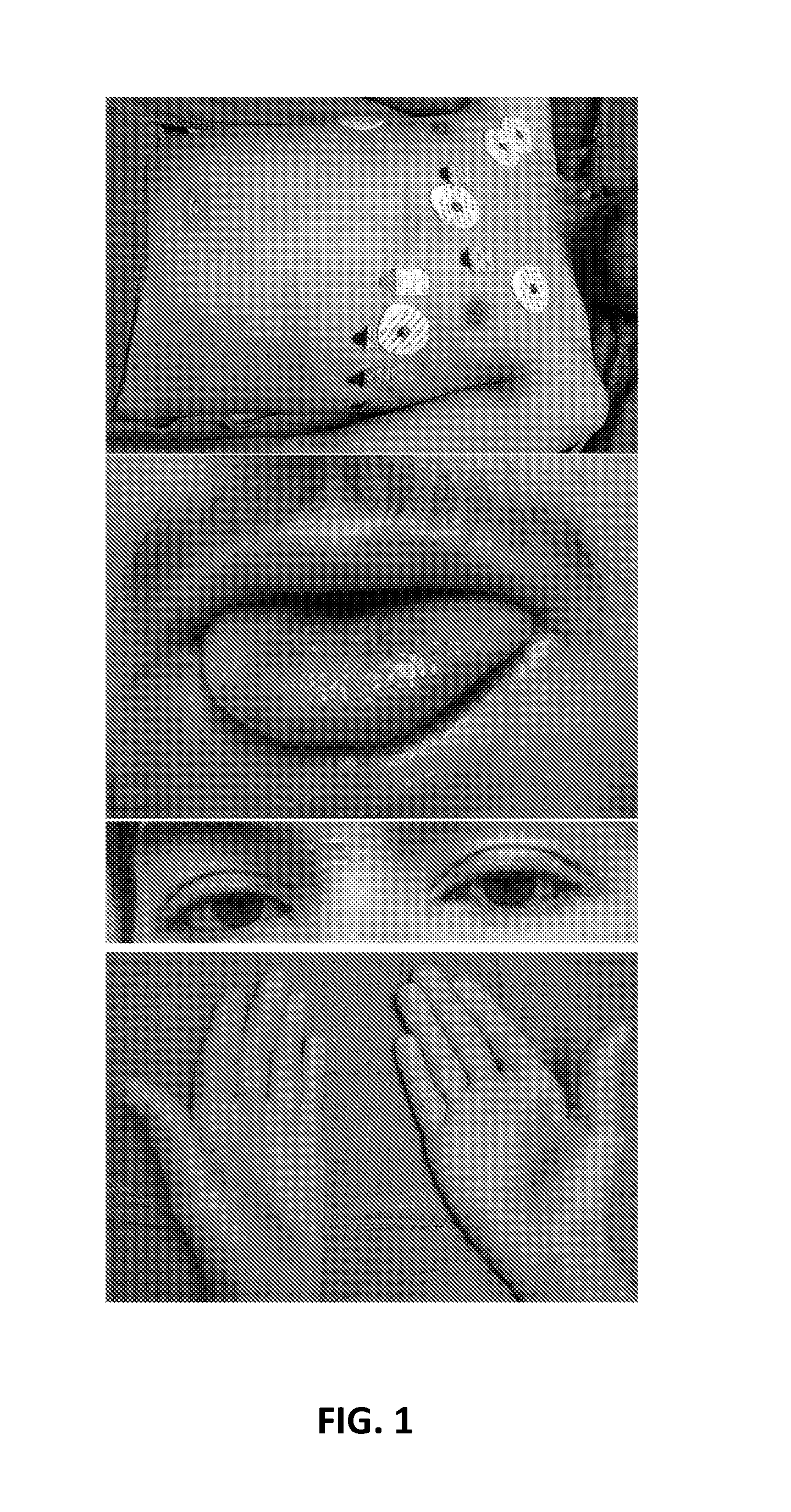 Material and methods for diagnosing and treating kawasaki disease and kls