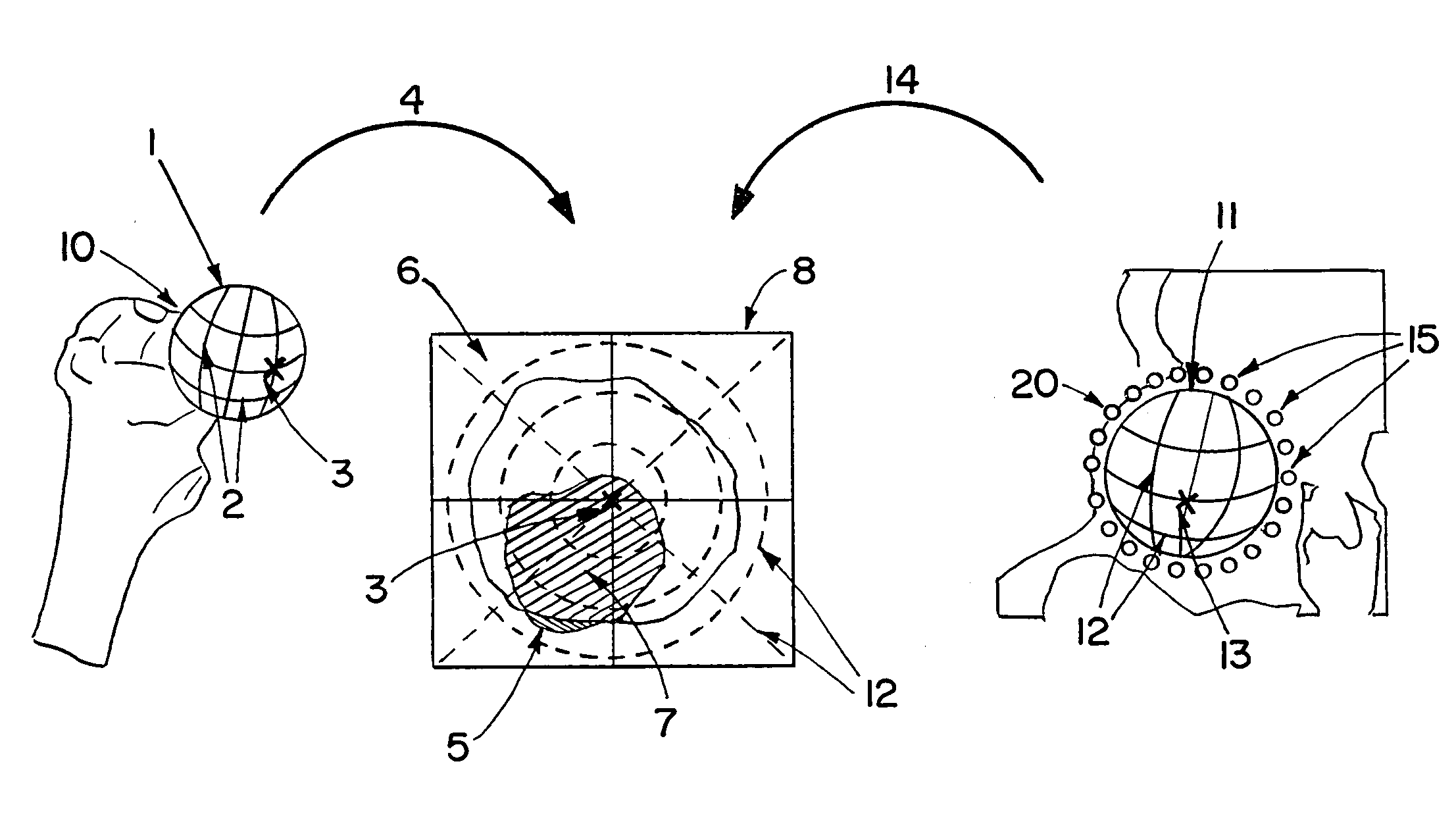 Computer-assisted joint analysis using surface projection