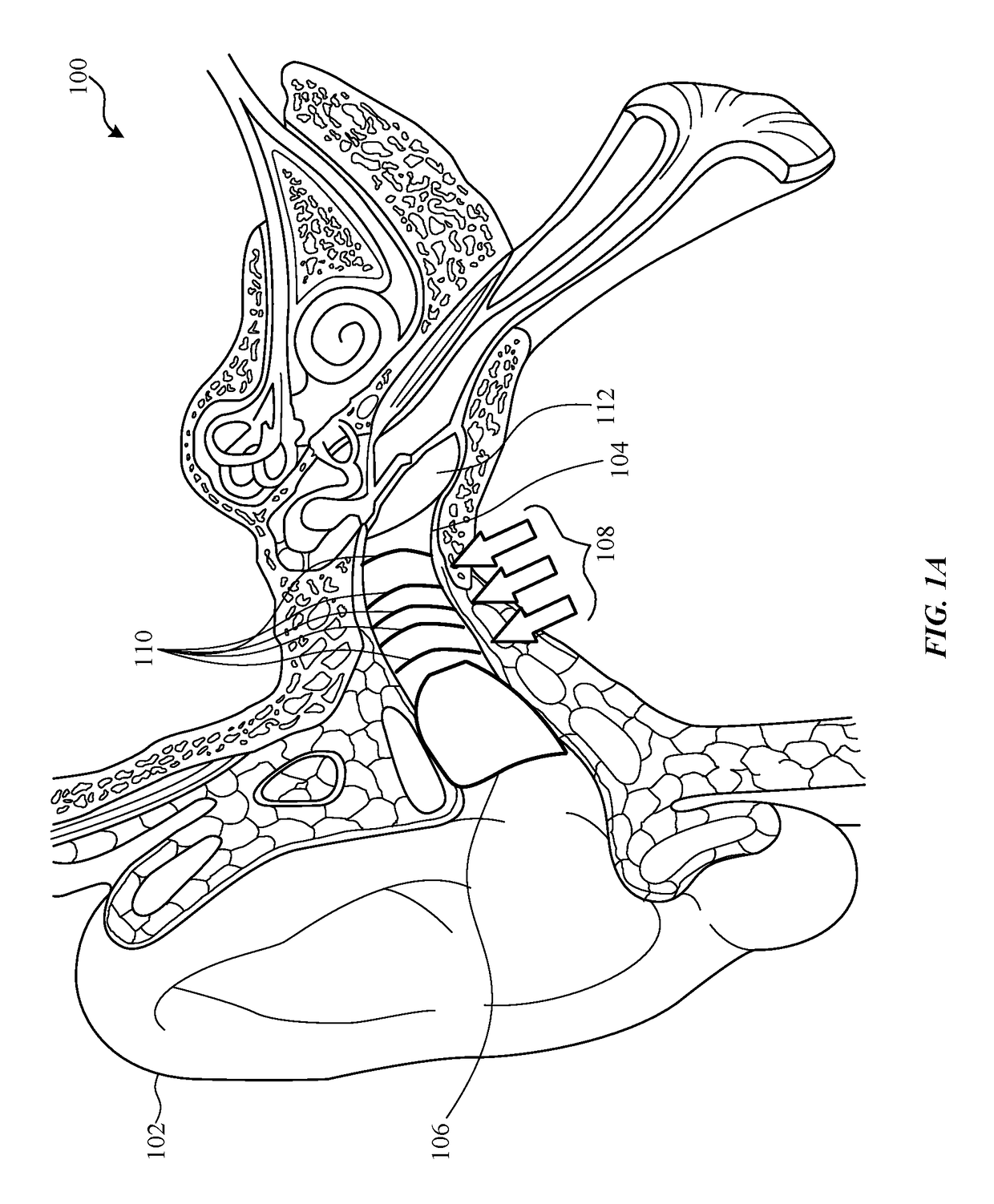 Balanced armature based valve