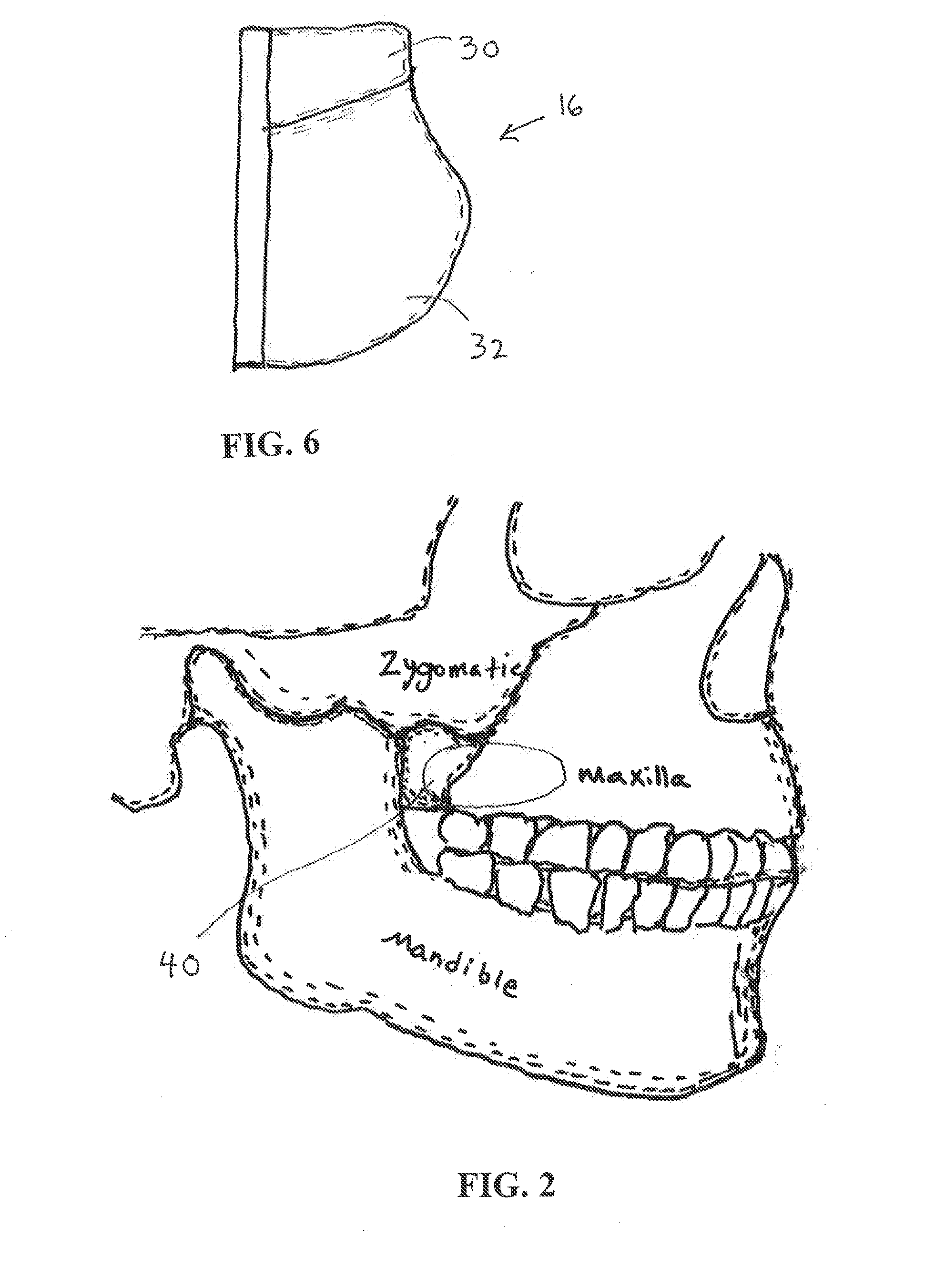 Cheek depressors and method of use