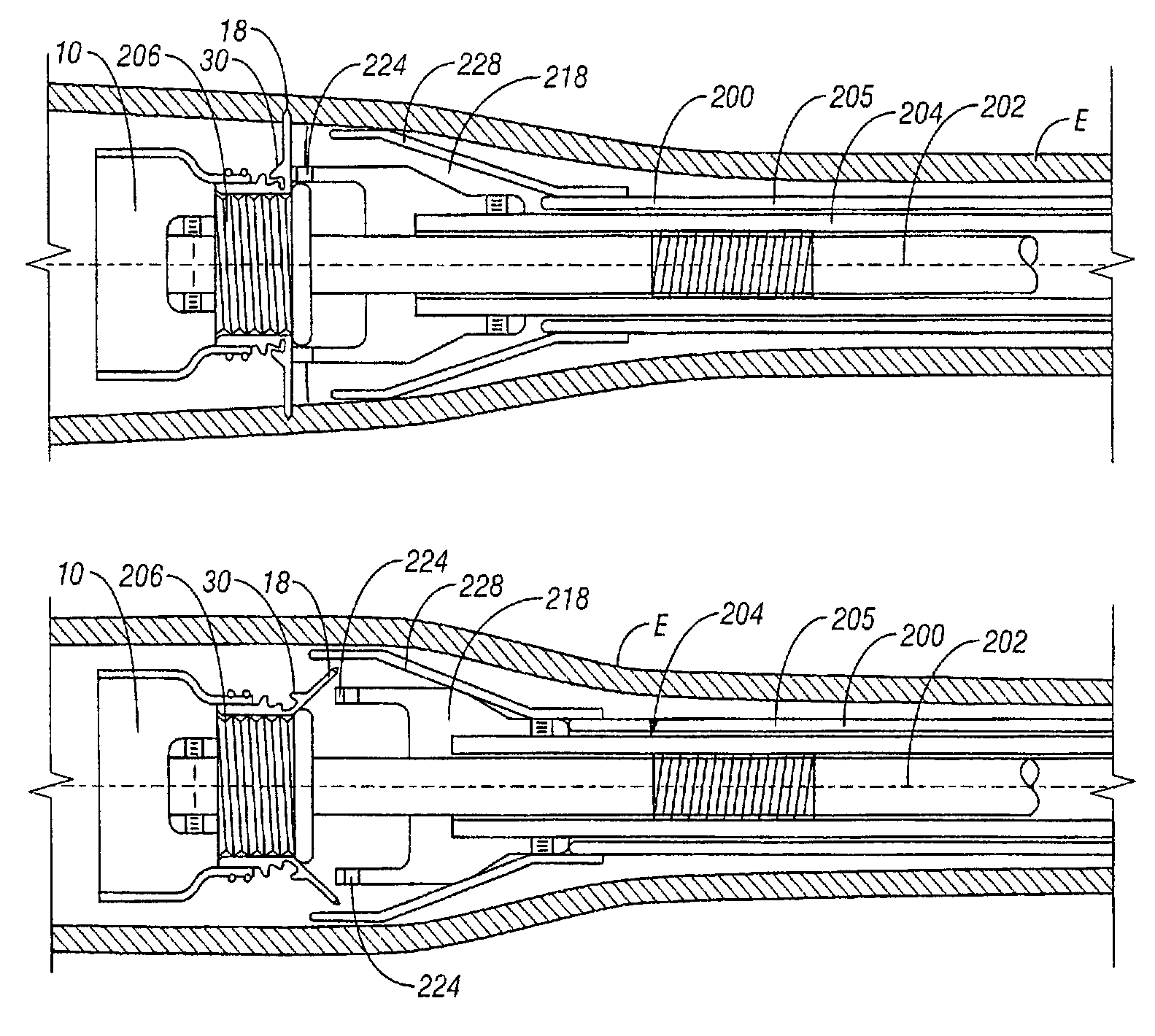 Perorally insertable/removable anti-reflux valve