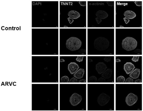 Method for establishing human arrhythmogenic right ventricular cardiomyopathy (ARVC) disease model