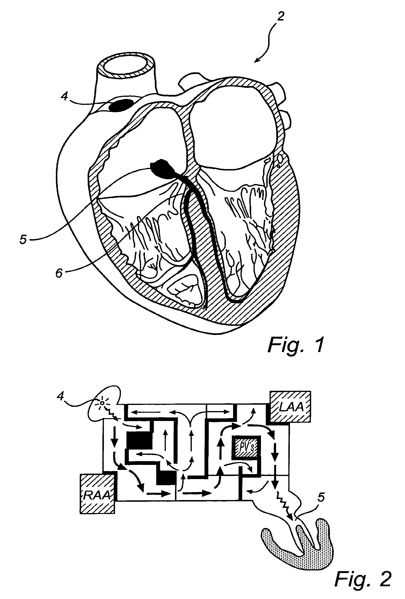 Device, A Kit And A Method For Treatment Of Disorders In The Heart Rhythm Regulation System