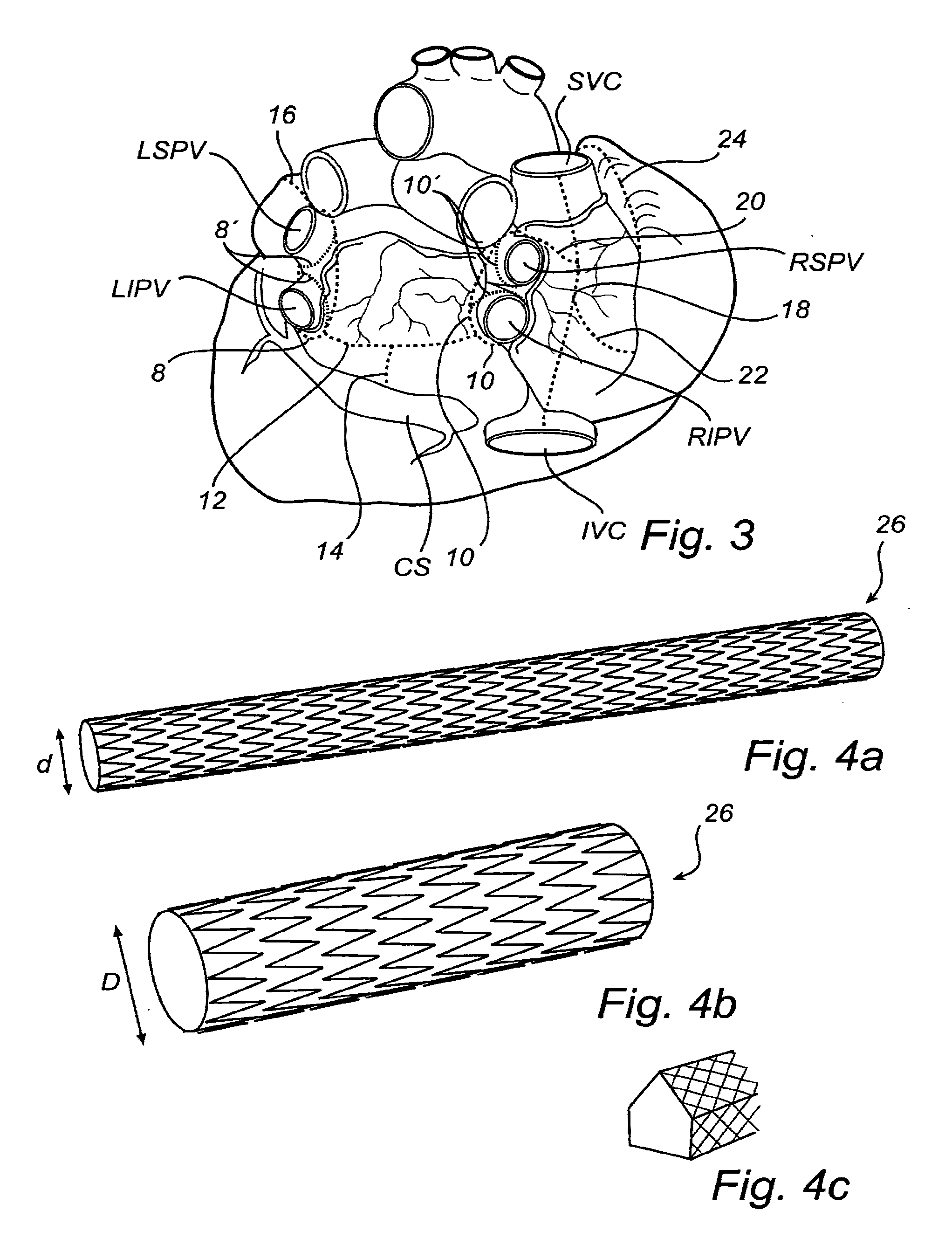 Device, A Kit And A Method For Treatment Of Disorders In The Heart Rhythm Regulation System