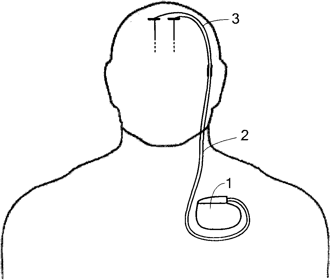 Embedded nerve stimulator with constant voltage/constant current dipulse mode