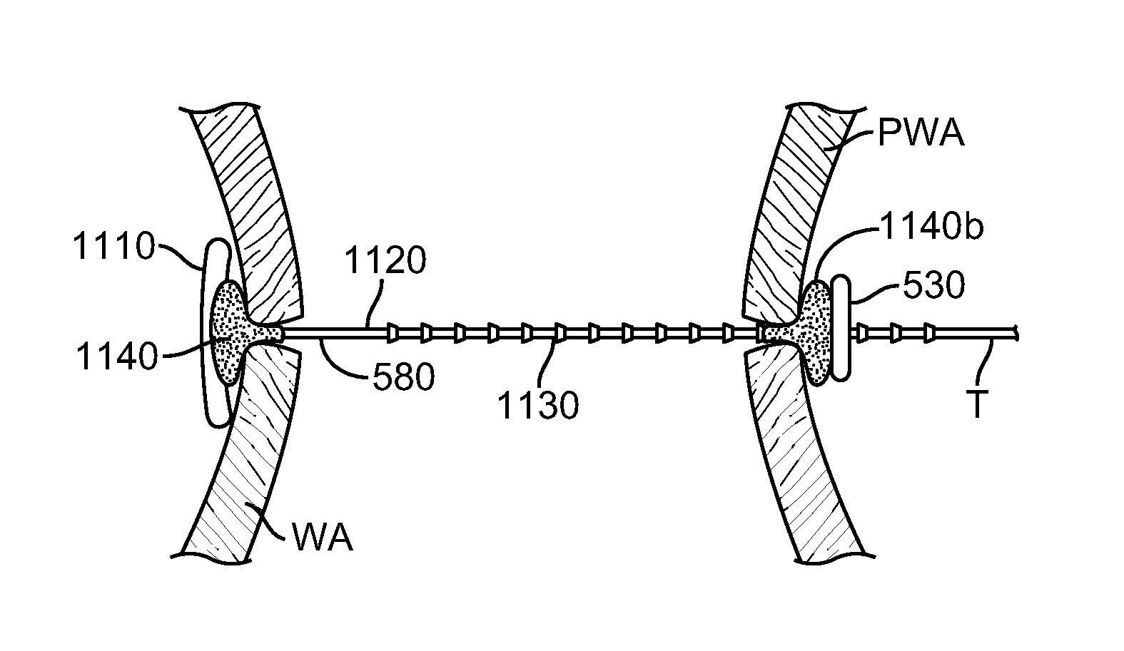 Cardiac anchor structures, methods, and systems for treatment of congestive heart failure and other conditions