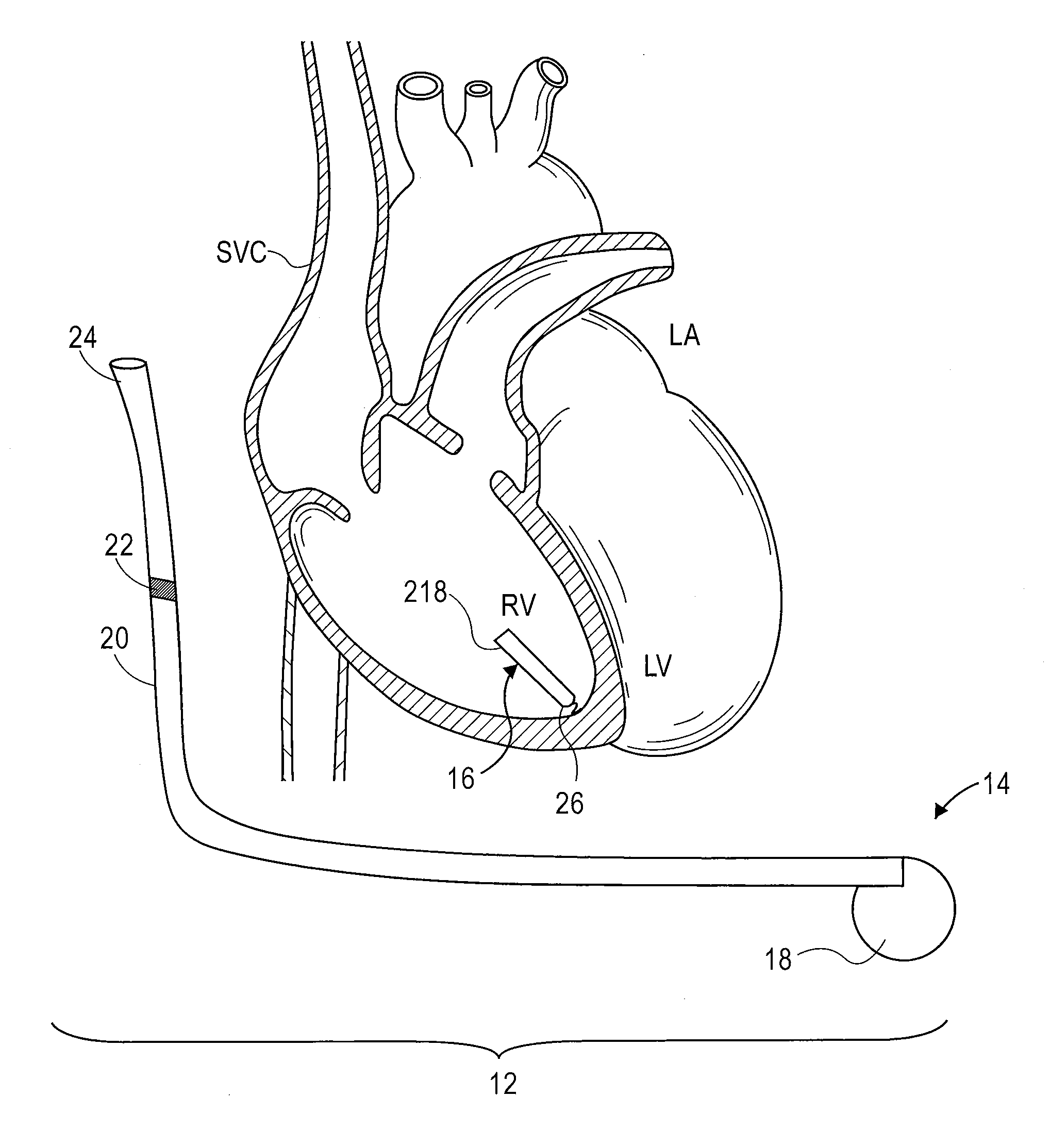 Method and system for tracking events of interest between leadless and subcutaneous implantable cardioverter devices