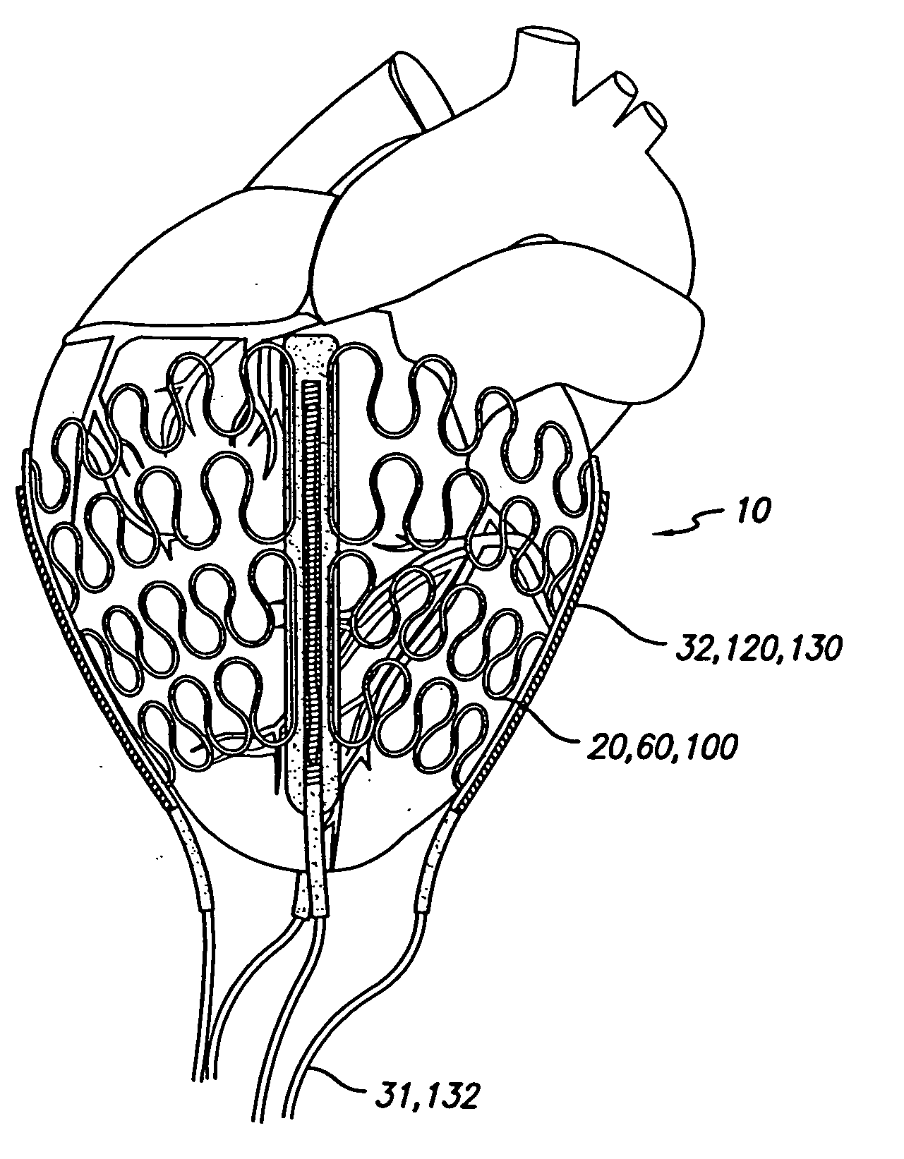 Cardiac harness for treating congestive heart failure and for defibrillating and/or pacing/sensing