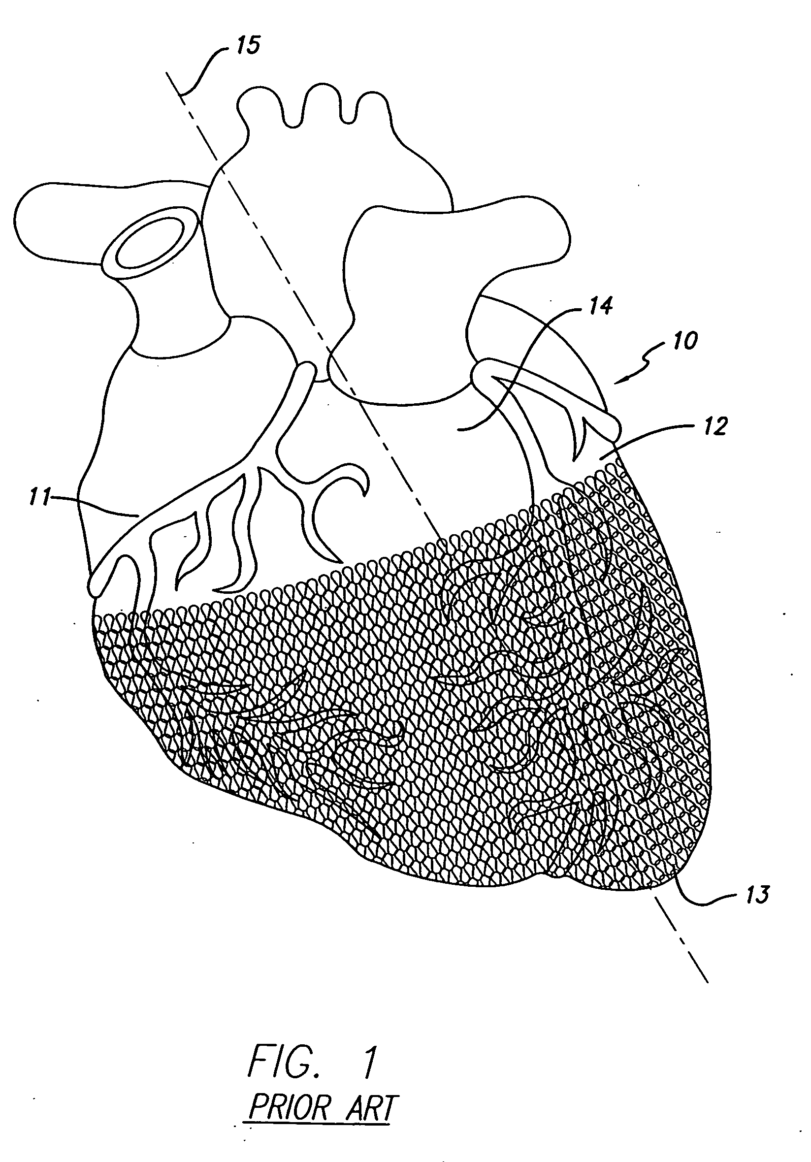 Cardiac harness for treating congestive heart failure and for defibrillating and/or pacing/sensing