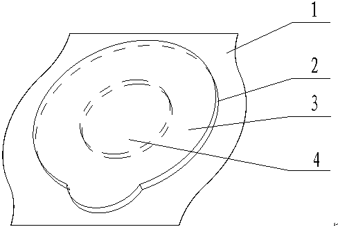 Intramuscular injection plaster