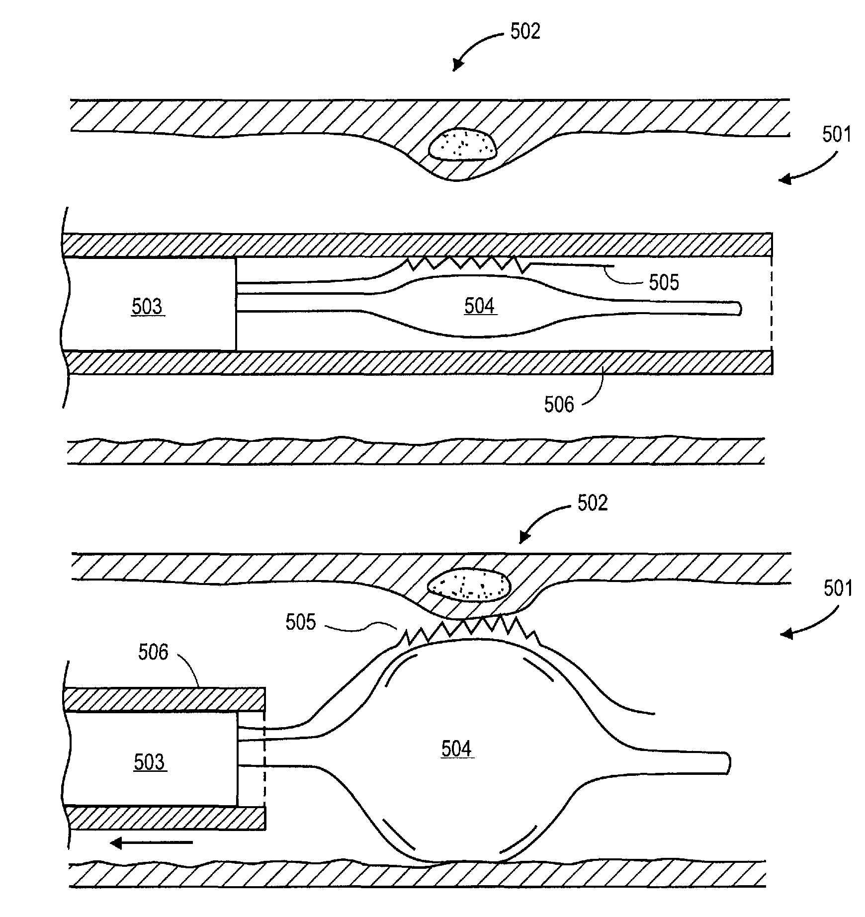 Method and apparatus for rupturing a vulnerable plaque