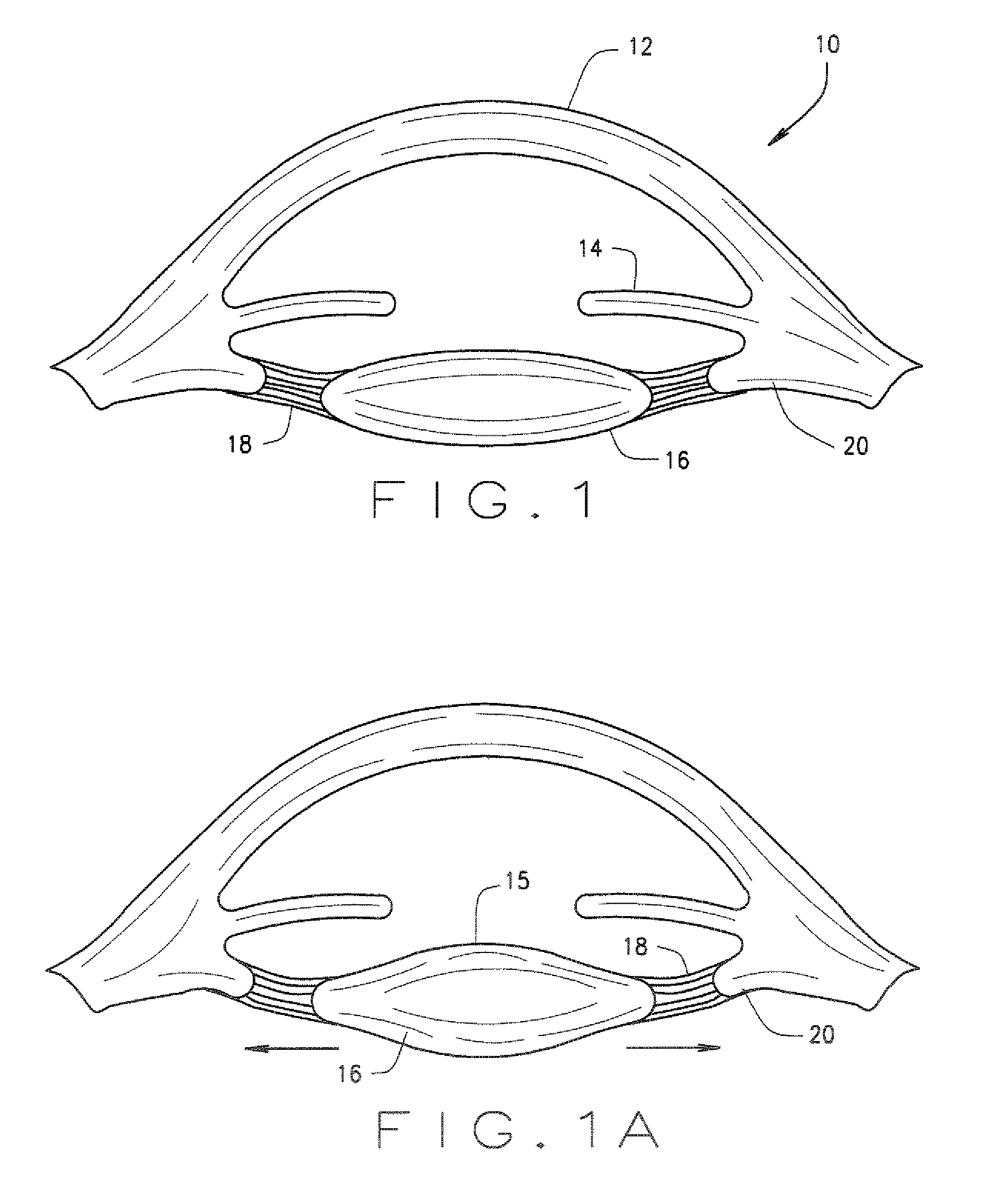 Ophthalmological zonular stretch segment for treating presbyopia