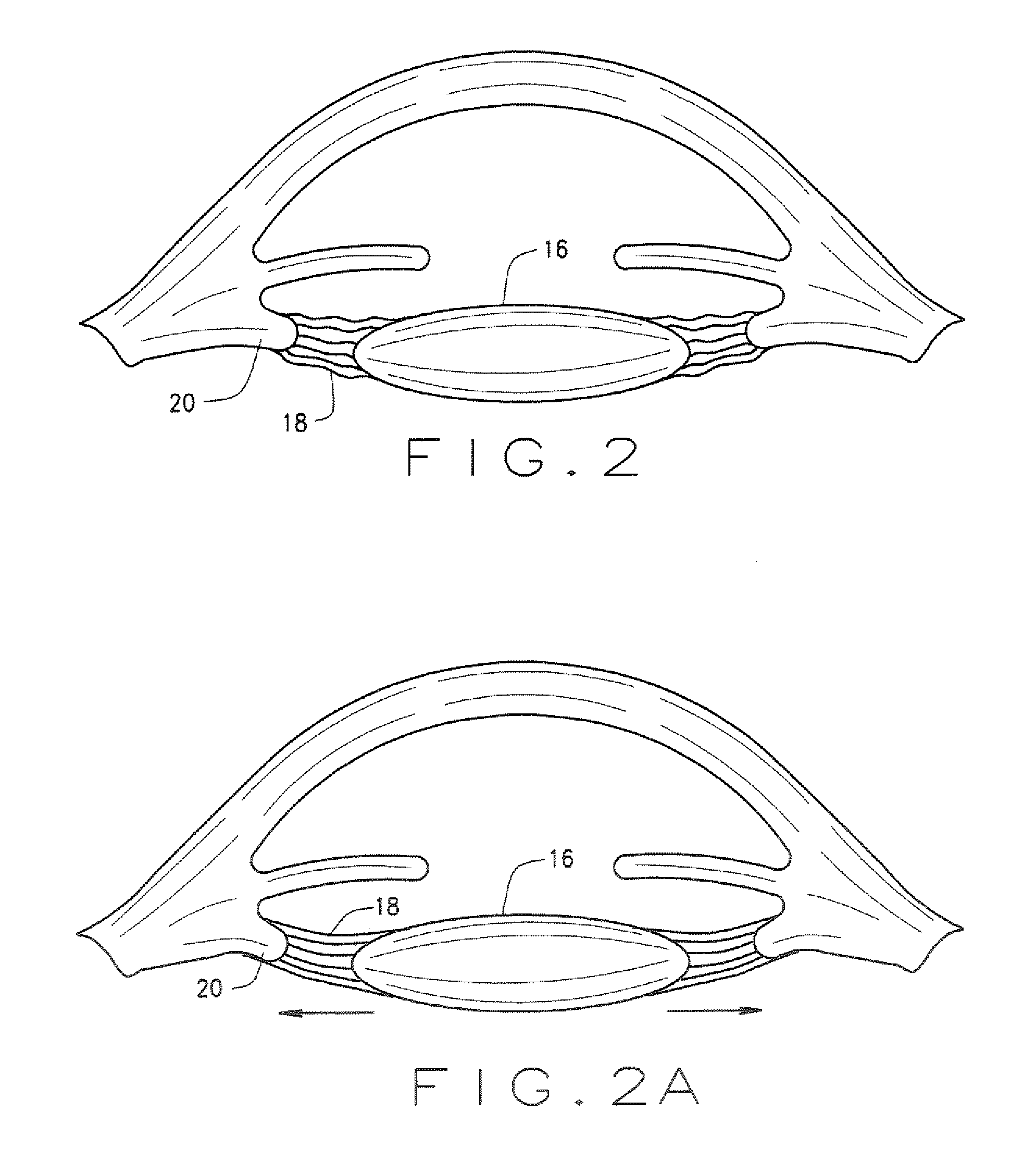 Ophthalmological zonular stretch segment for treating presbyopia