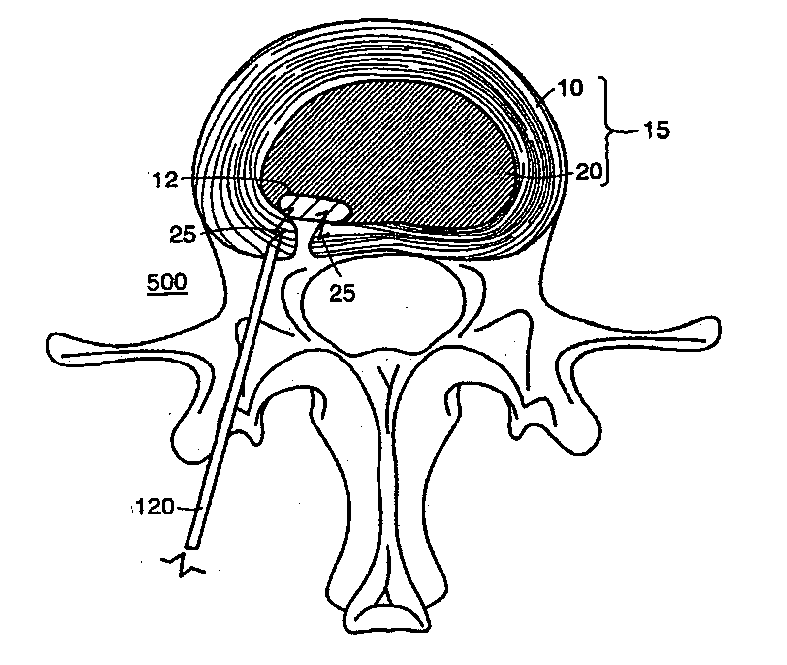 Intervertebral disc herniation repair