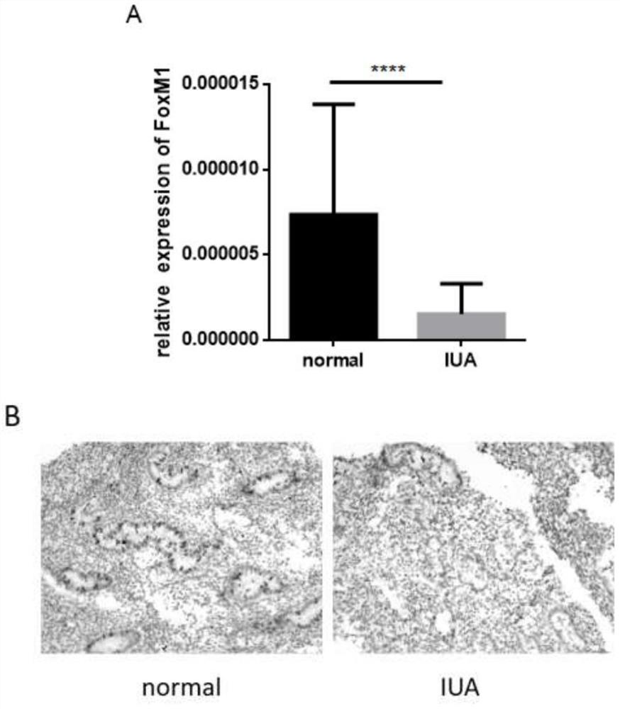 Application of foxm1 in the diagnosis and treatment of intrauterine adhesion disease