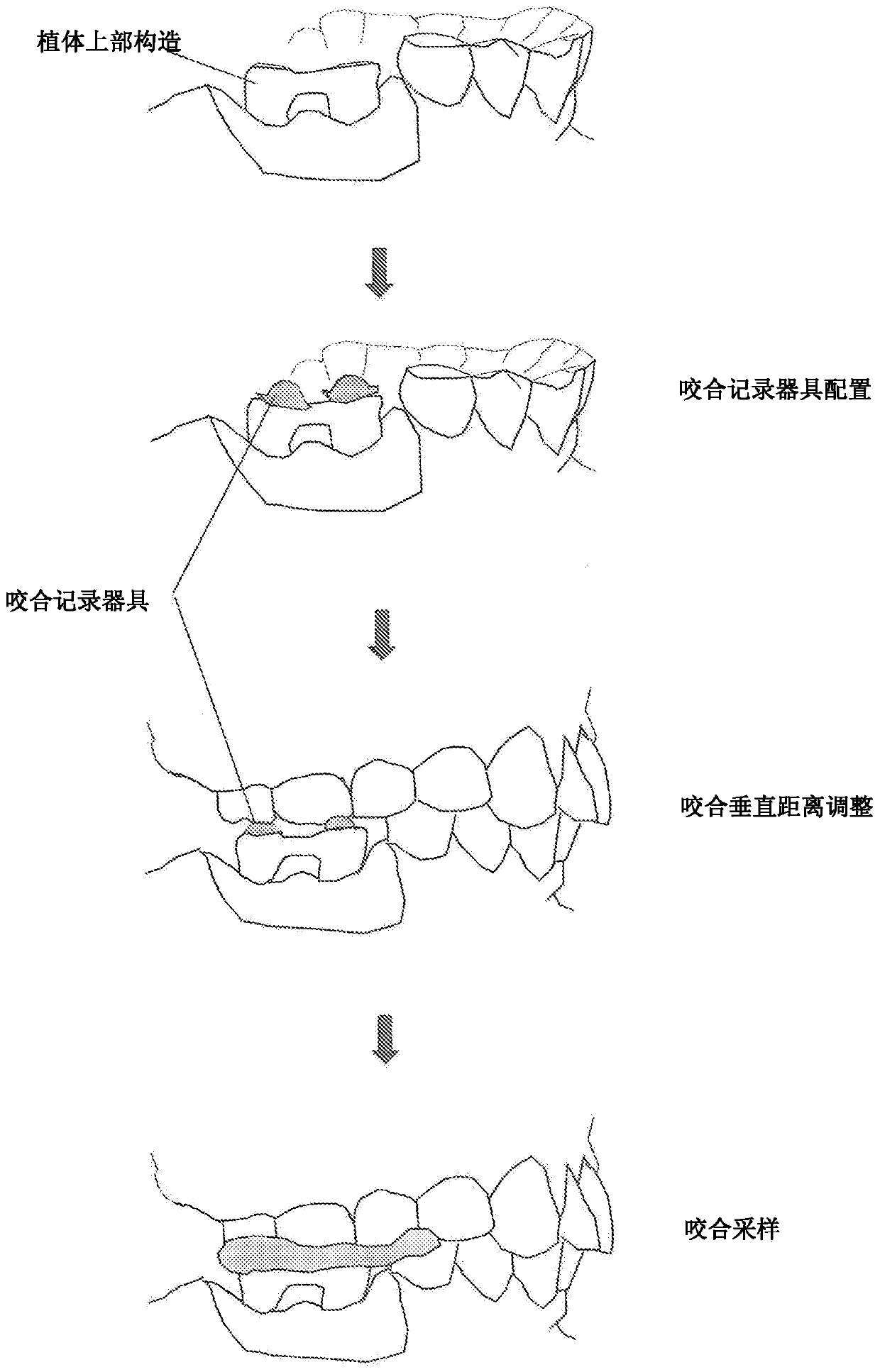 Occlusion recording instrument and articulator