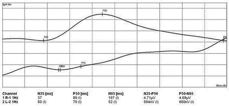 Method for recording pattern electroretinogram under complicated electromagnetic interference conditions