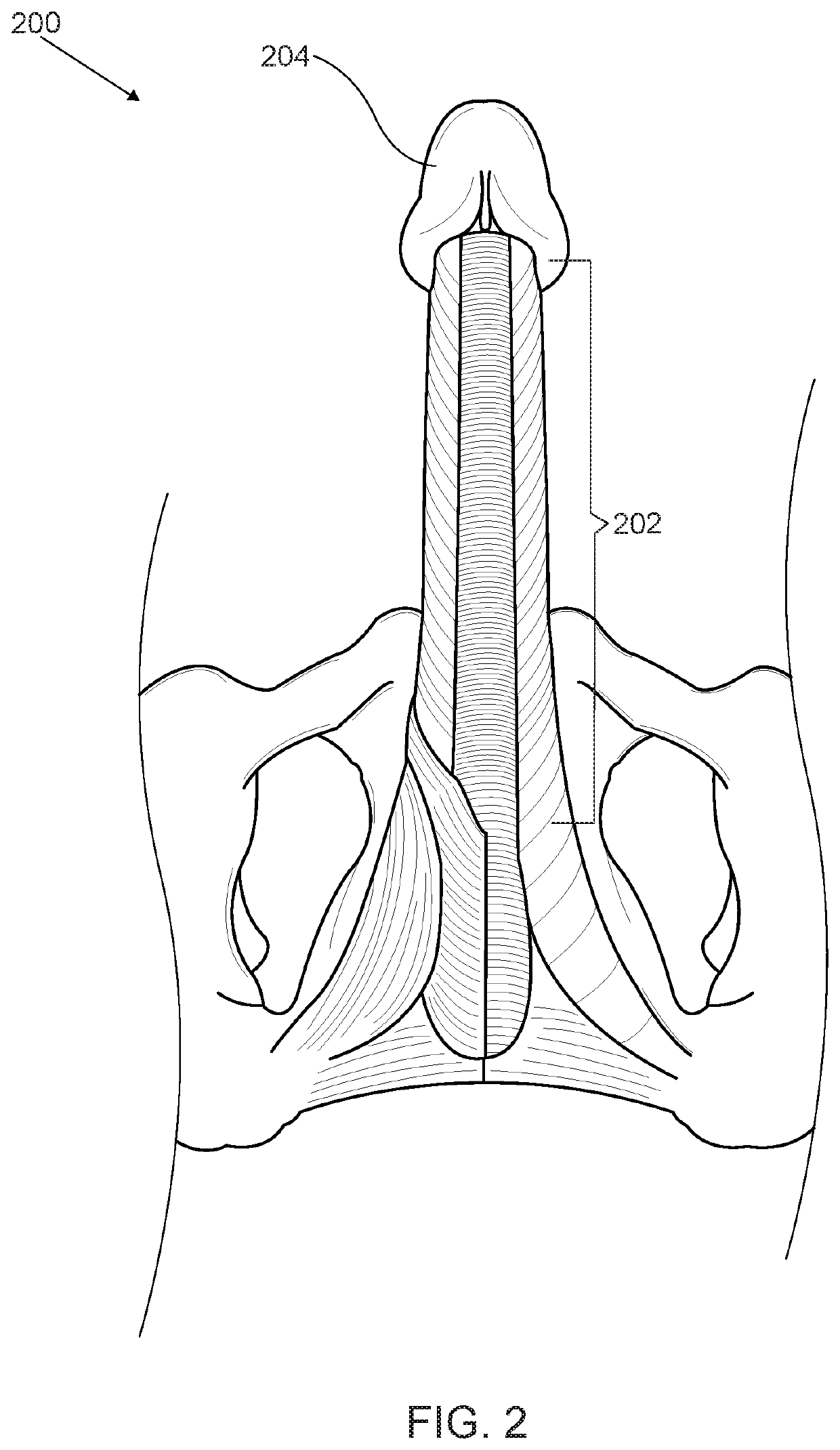 Zeus Protocol Method for Enhancing Male Sexual Wellness with Shockwave Therapy and Stem Cells