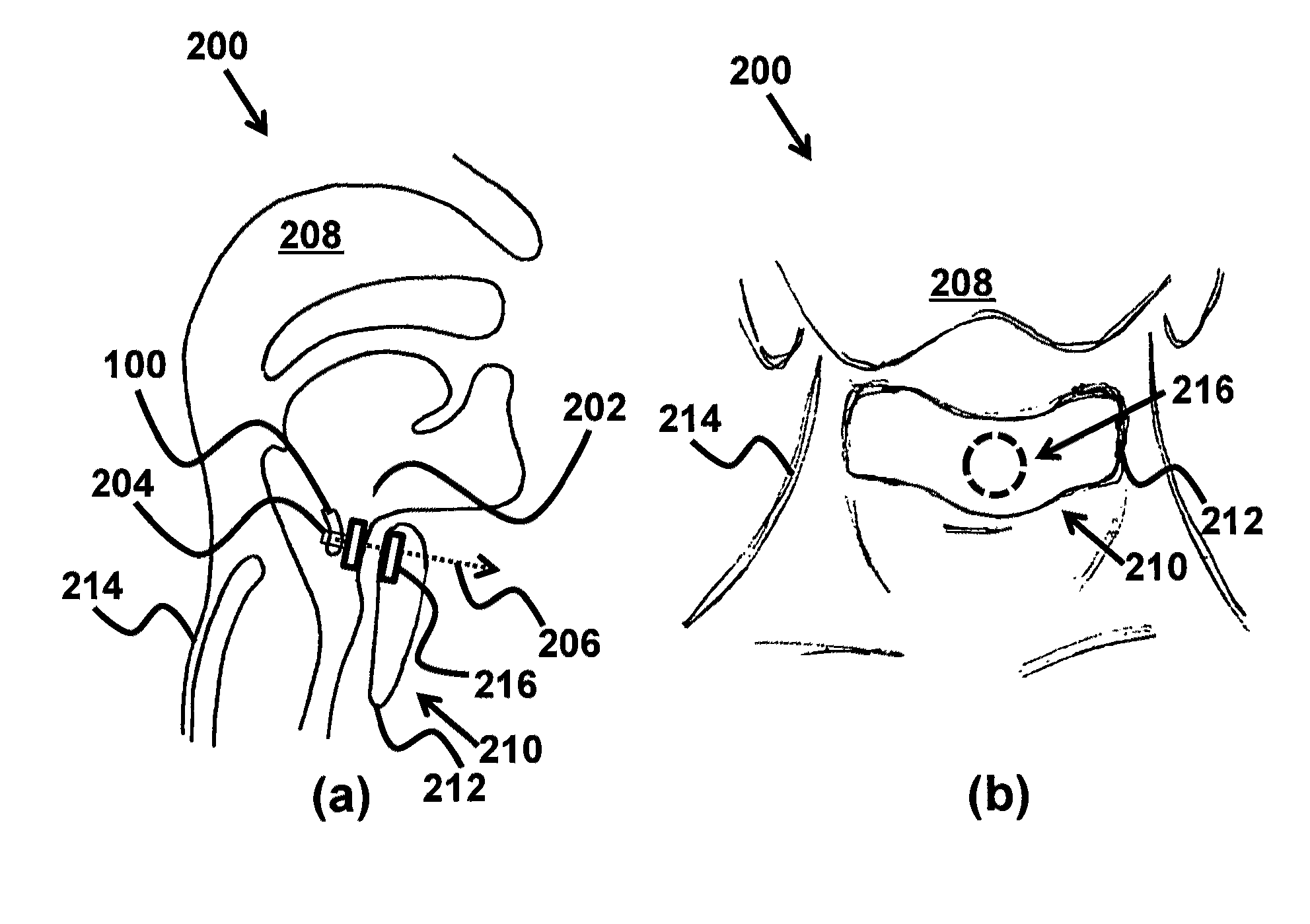 Device and method for correcting obstructive sleep apnea