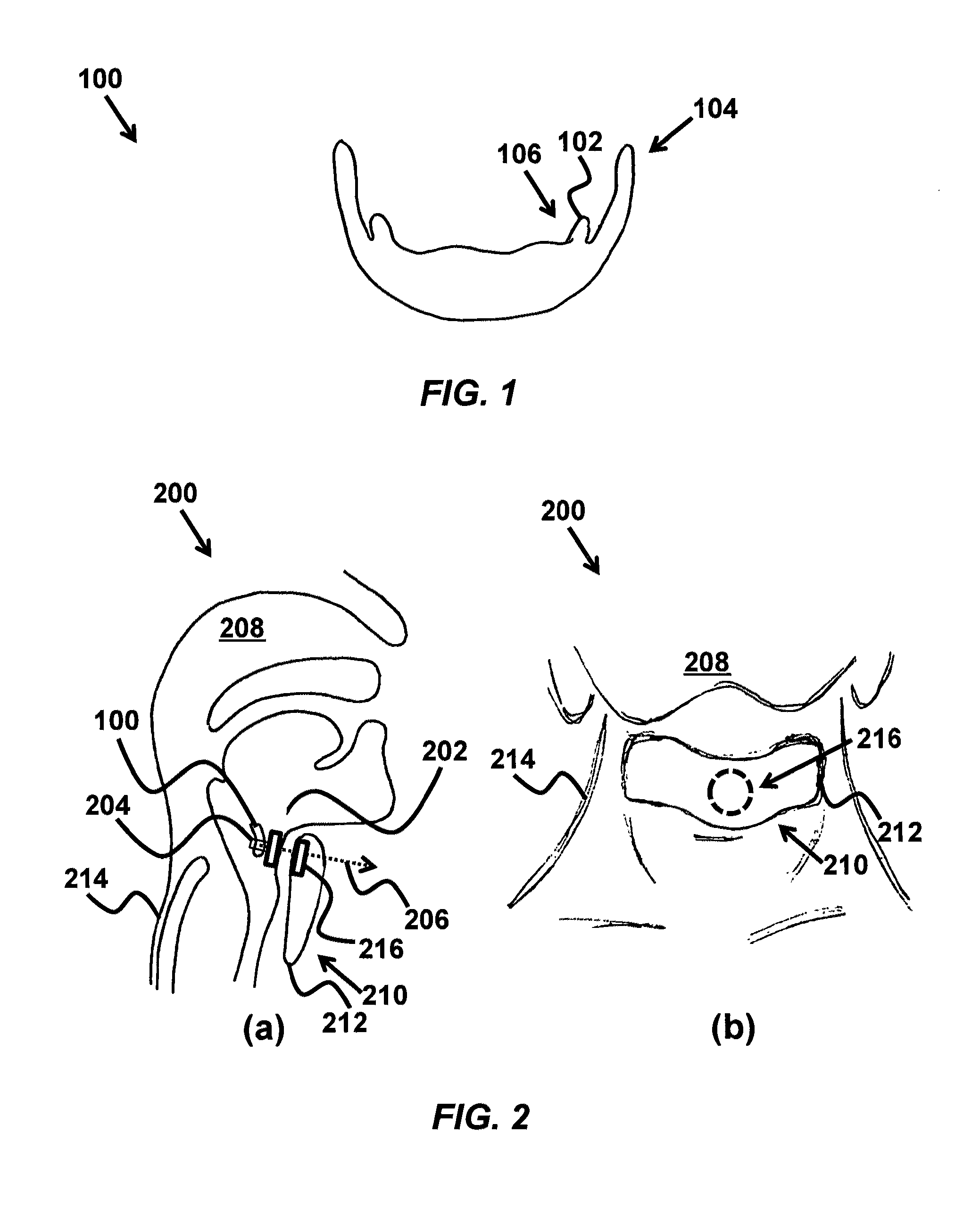 Device and method for correcting obstructive sleep apnea