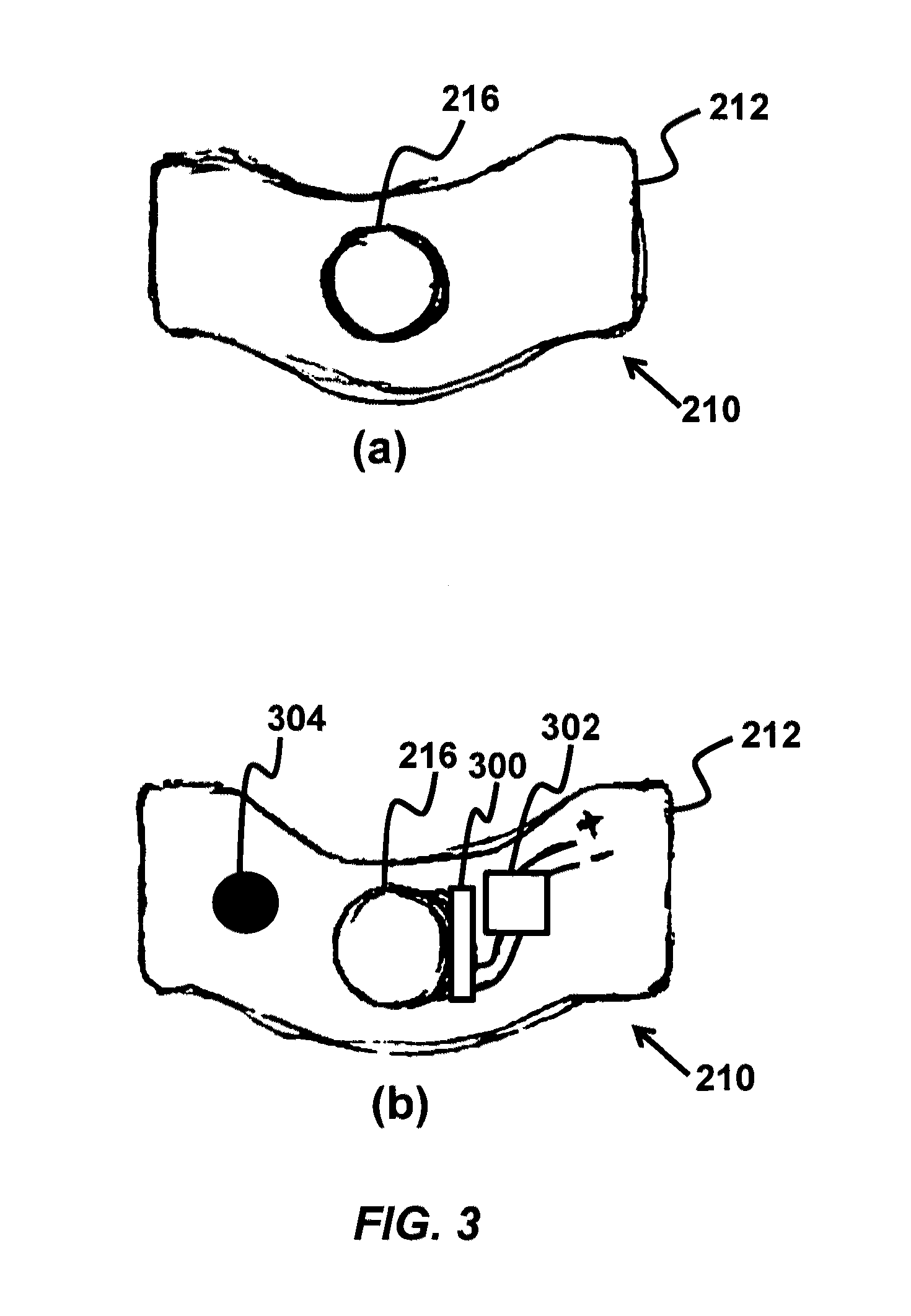 Device and method for correcting obstructive sleep apnea