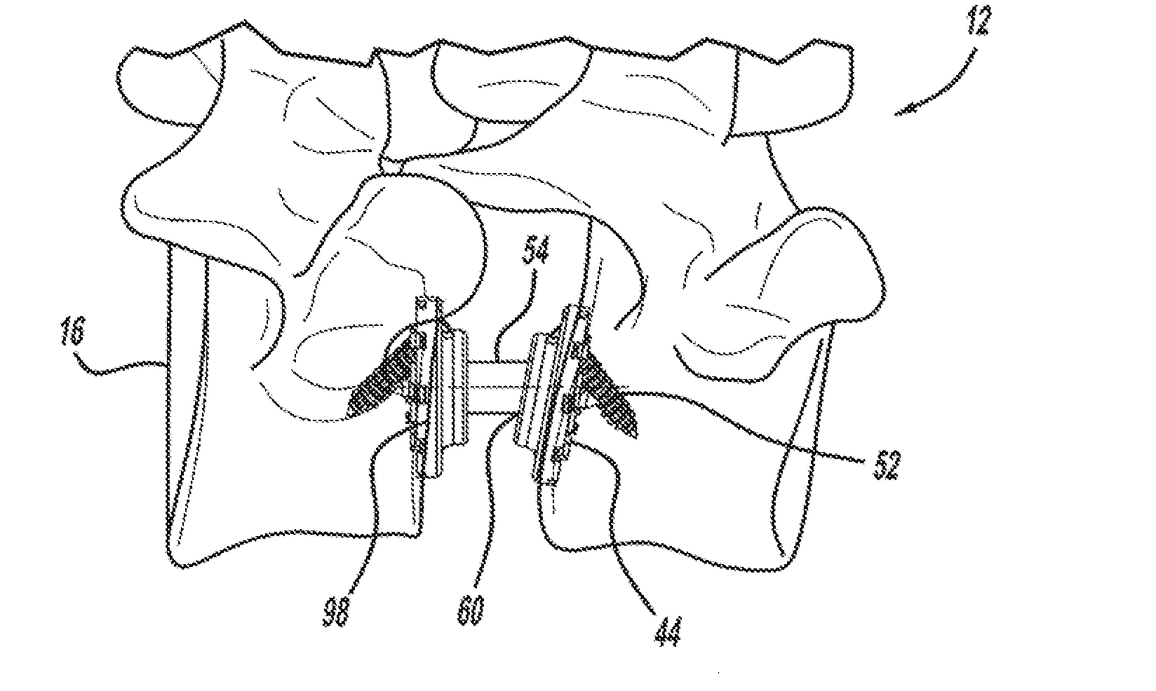 Method and implant device for grafting adjacent vertebral bodies