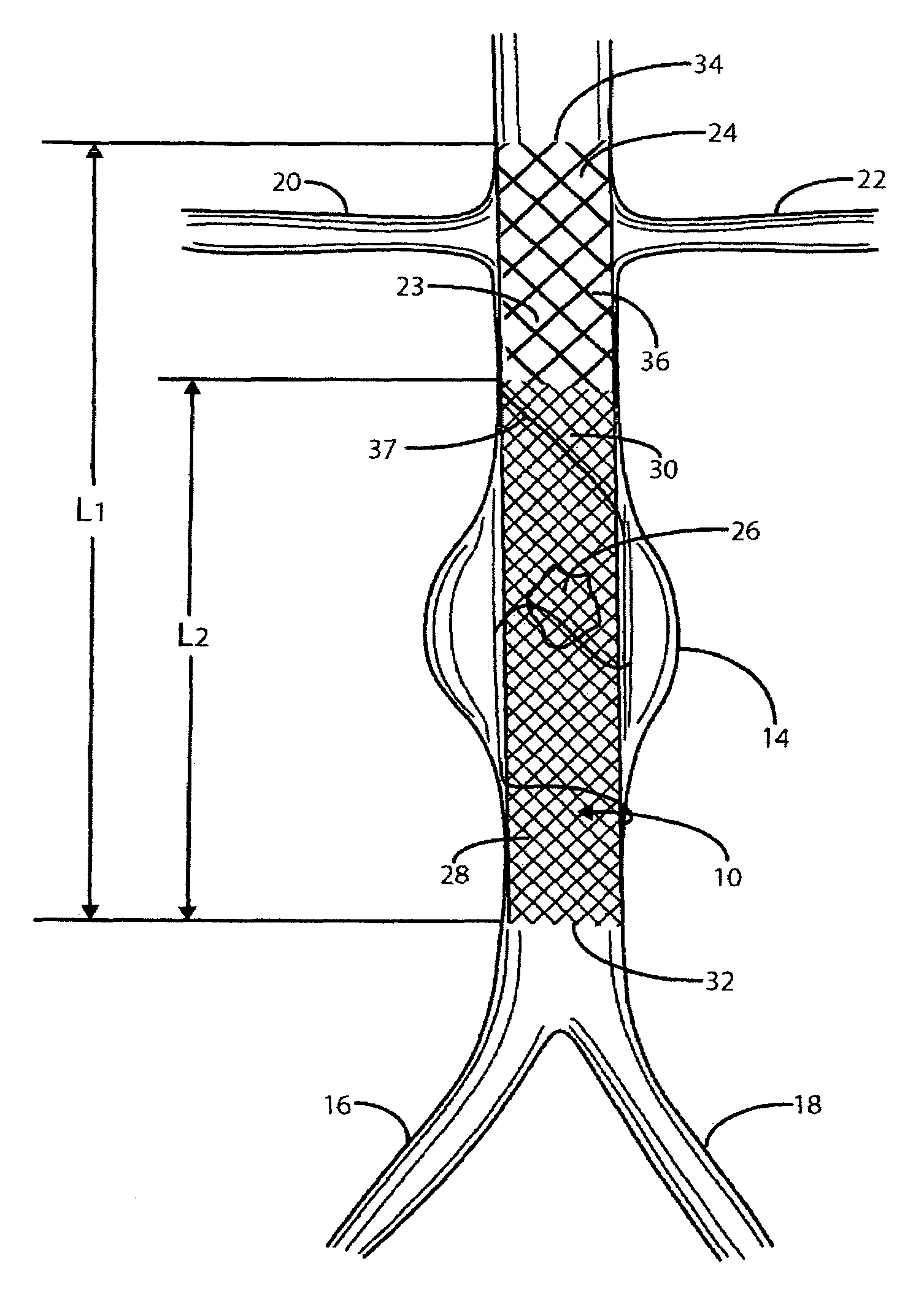 Intravascular deliverable stent for reinforcement of vascular abnormalities