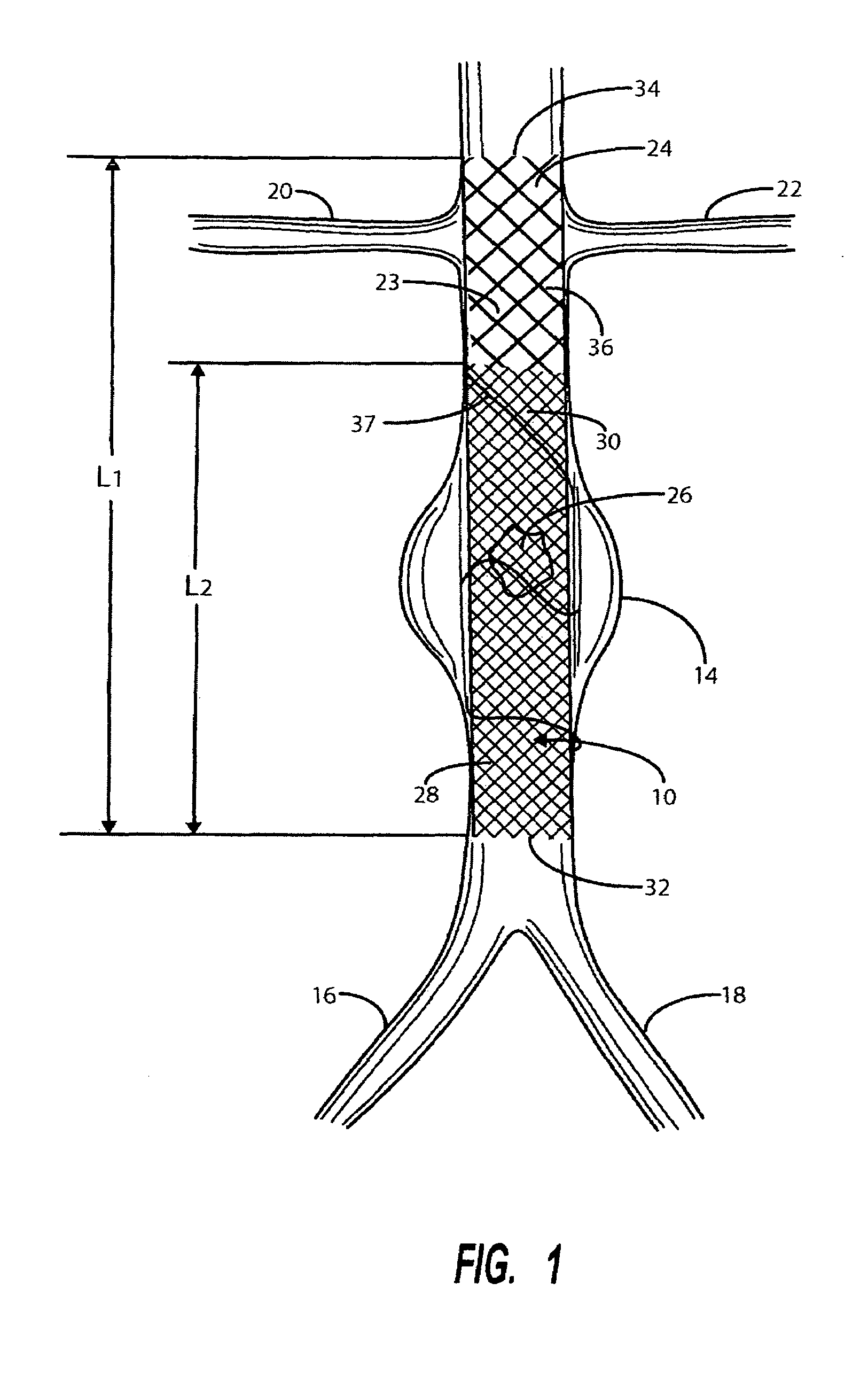 Intravascular deliverable stent for reinforcement of vascular abnormalities