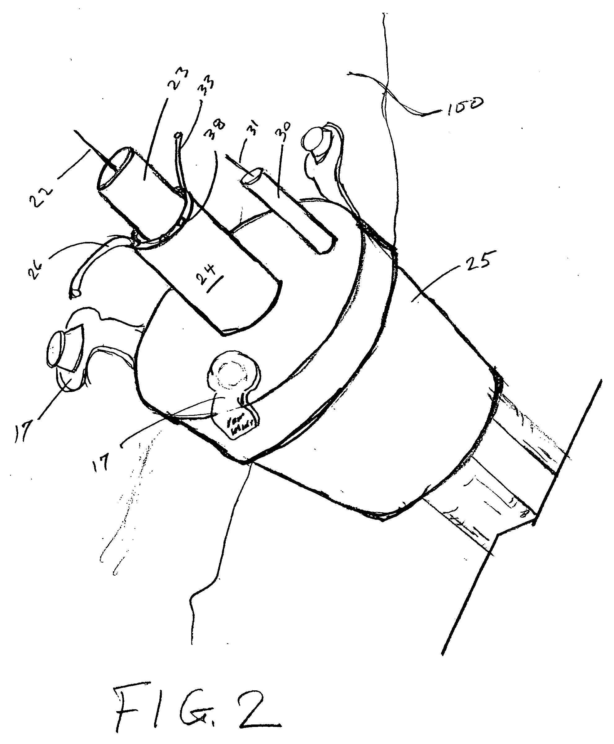 Catheter for treatment of severe pulmonary emboli