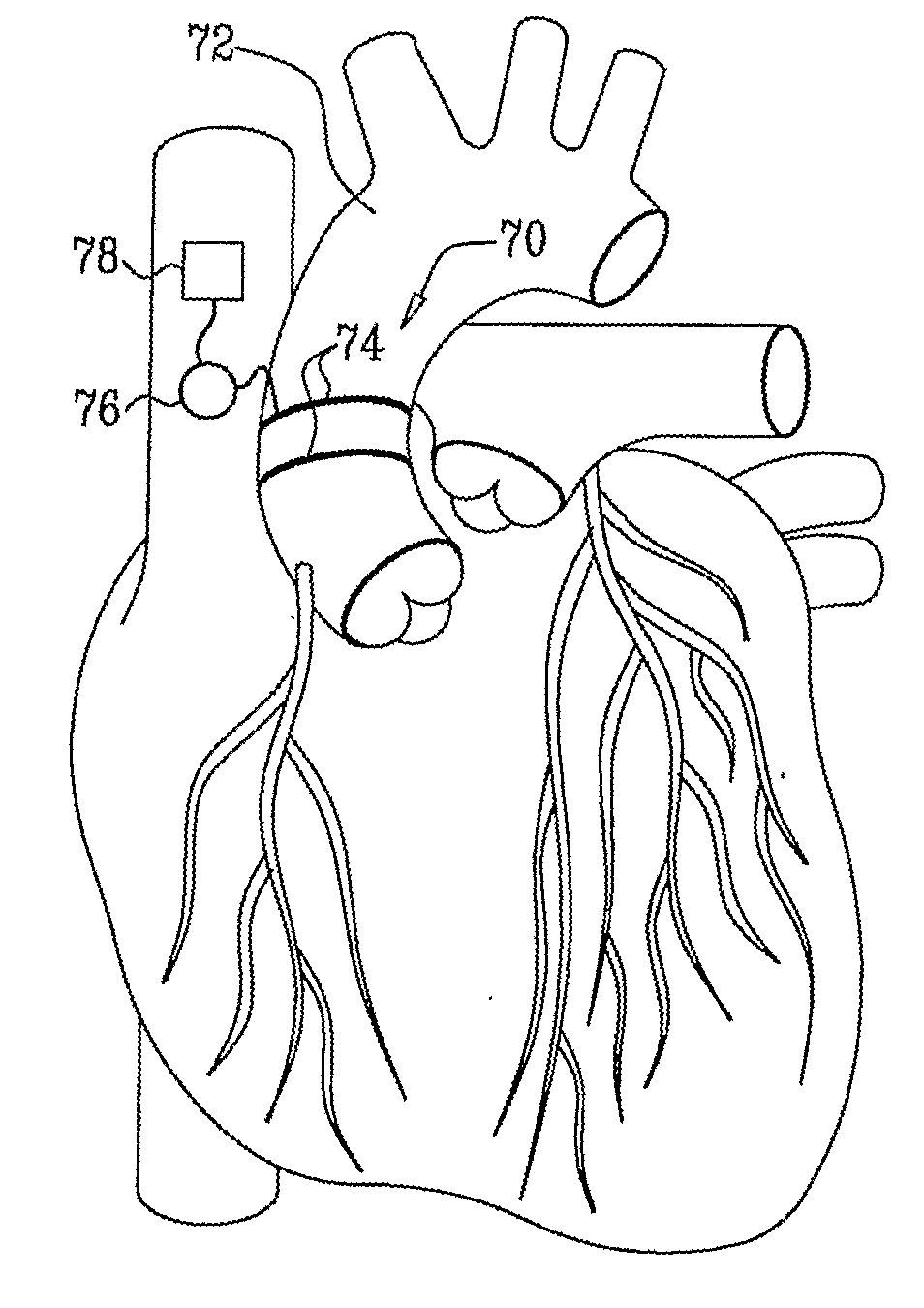 Electrical Stimulation of Blood Vessels