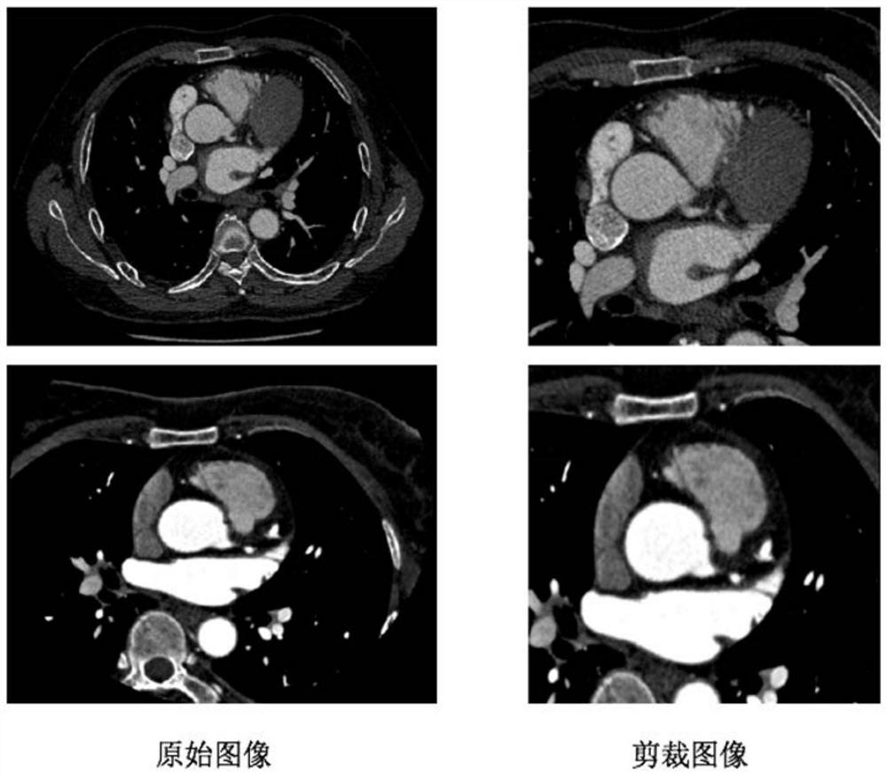 Coronary vessel extraction method and device based on multi-view model fusion