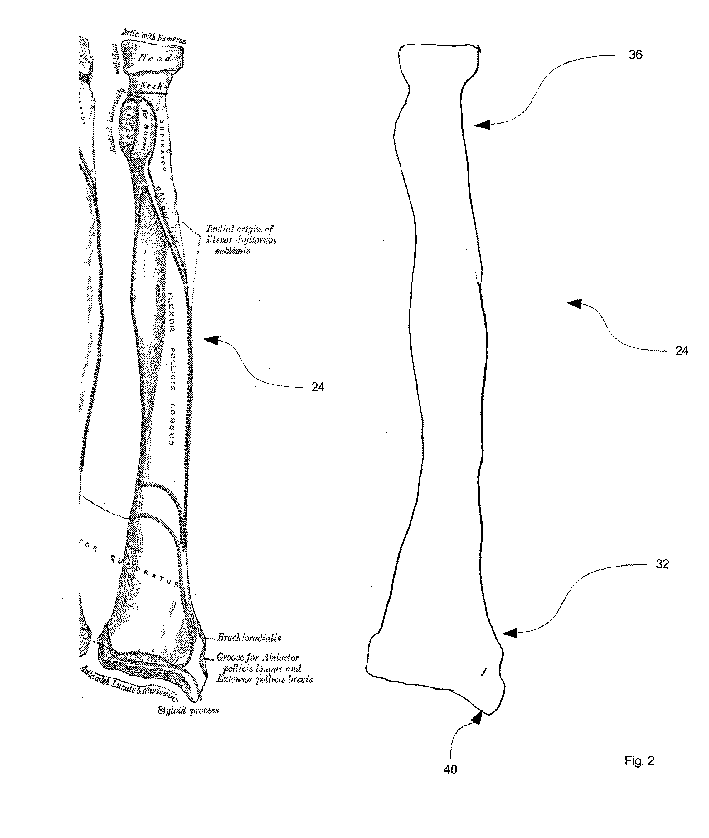 Method and kit for intra osseous navigation and augmentation of bone