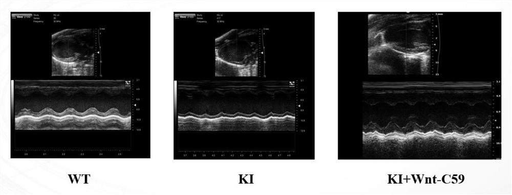 Application of Wnt inhibitor Wnt-C59 in preparation of medicine for treating dilated cardiomyopathy caused by SCN5A mutation