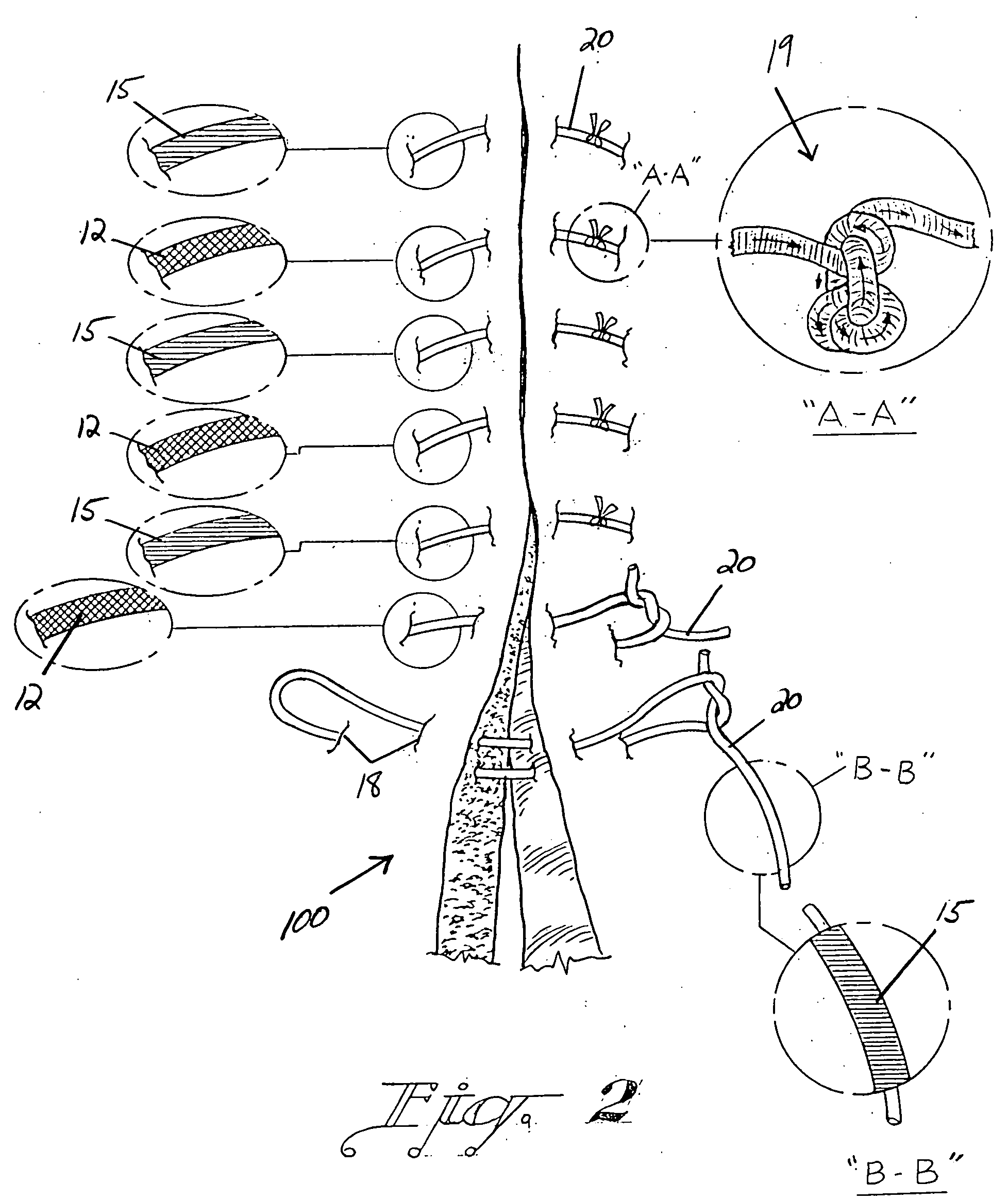 Suture treatment method and kit therefor