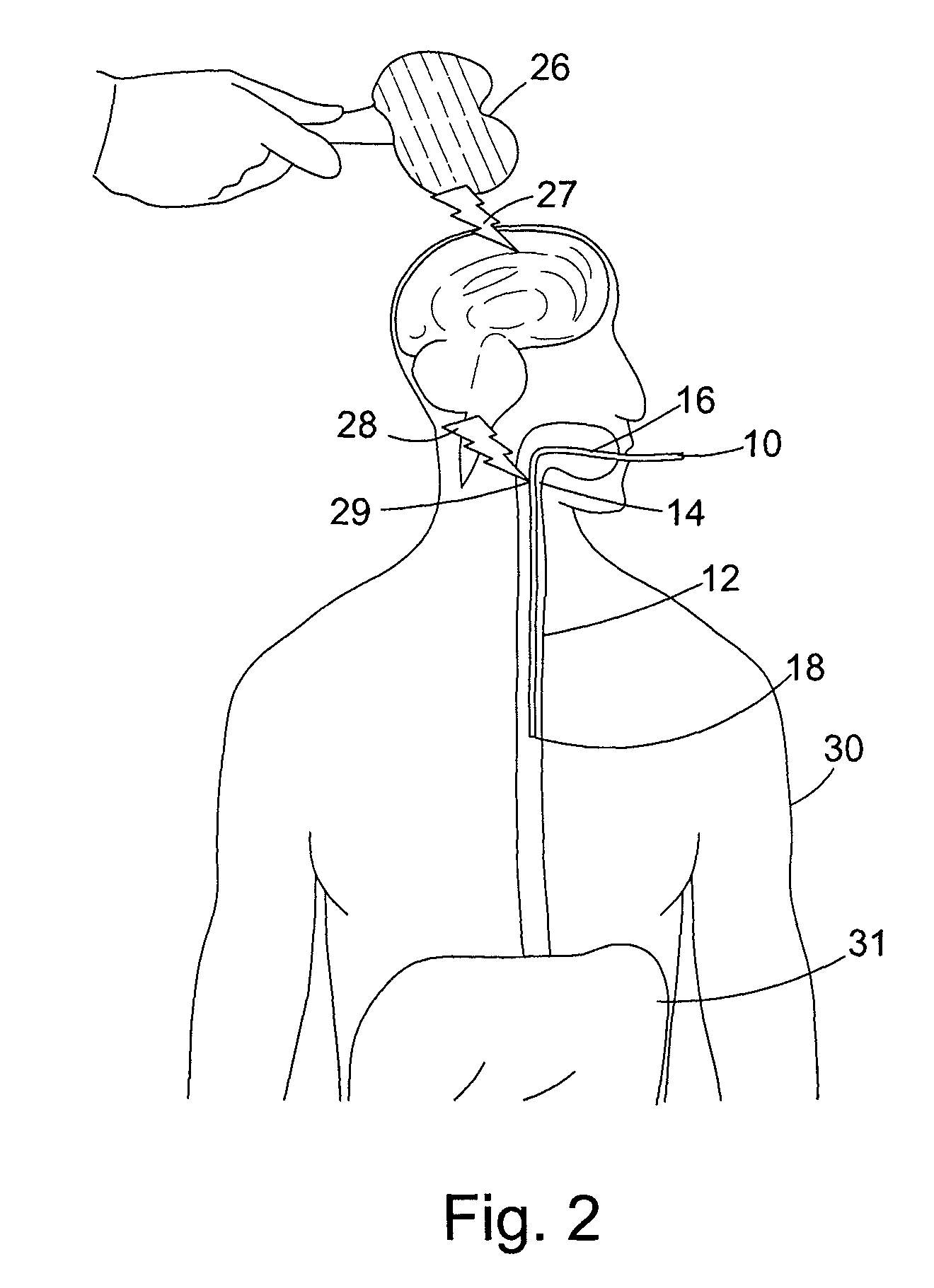 Dysphagia recovery by electrical stimulation