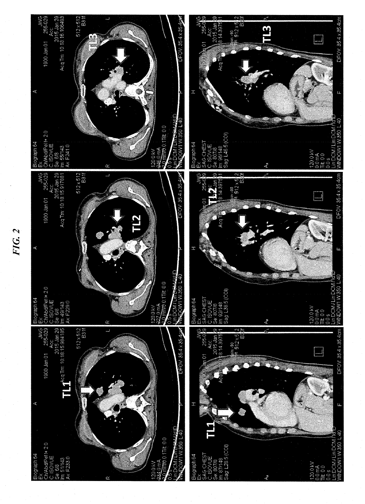 Efficacy of anti-trop-2-SN-38 antibody drug conjugates for therapy of tumors relapsed/refractory to checkpoint inhibitors