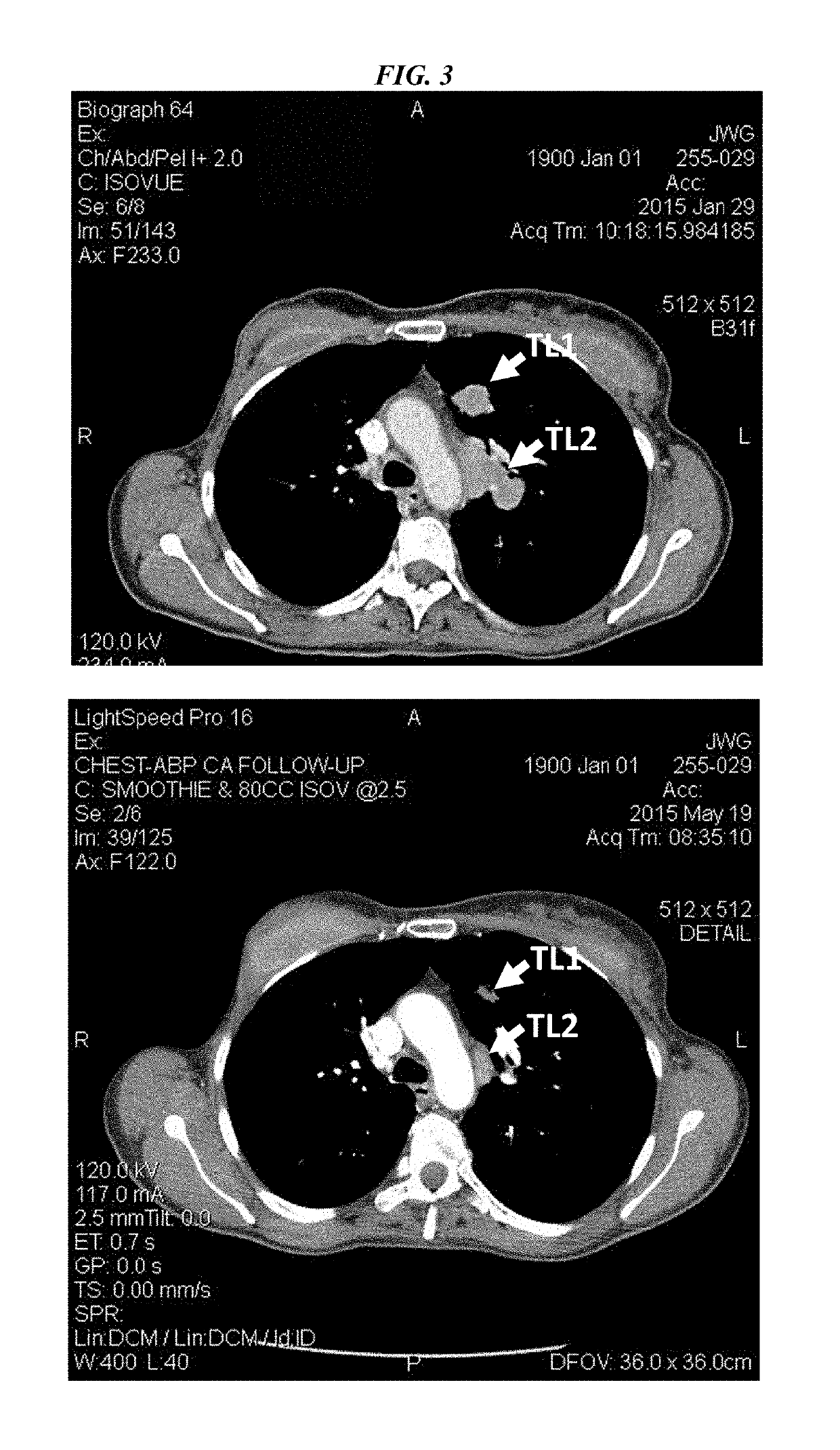 Efficacy of anti-trop-2-SN-38 antibody drug conjugates for therapy of tumors relapsed/refractory to checkpoint inhibitors