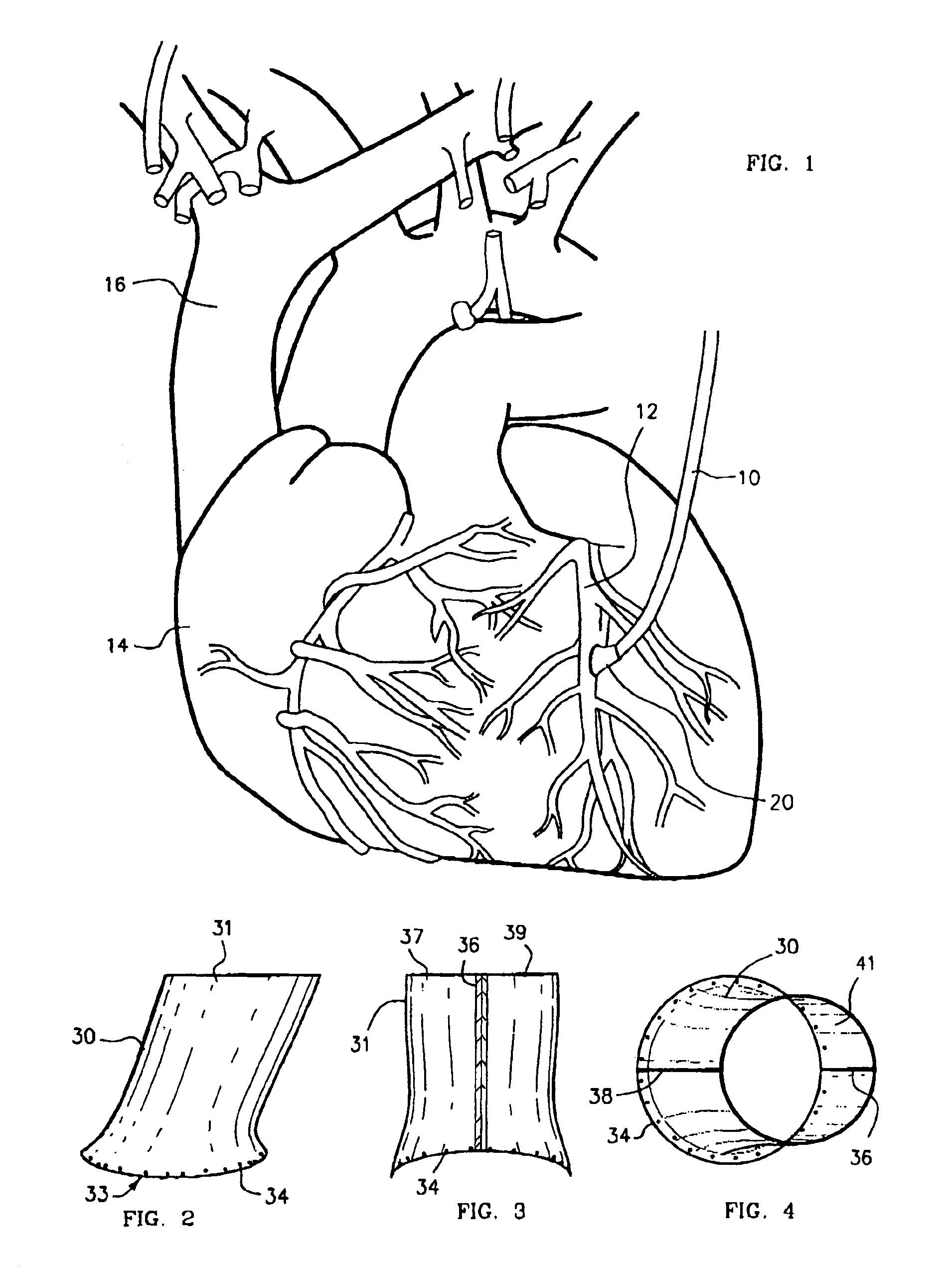 Method and coupling apparatus for facilitating an vascular anastomoses