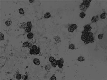 In situ hybridization detection kit for mRNA level at precancerous stage of breast cancer, detection method and application thereof