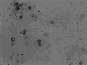 In situ hybridization detection kit for mRNA level at precancerous stage of breast cancer, detection method and application thereof