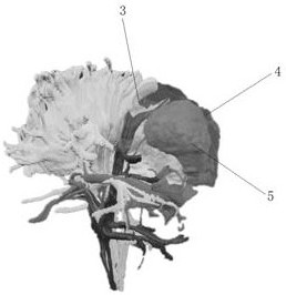 Deep brain tumor and white matter fiber bundle relation model and preparation method thereof