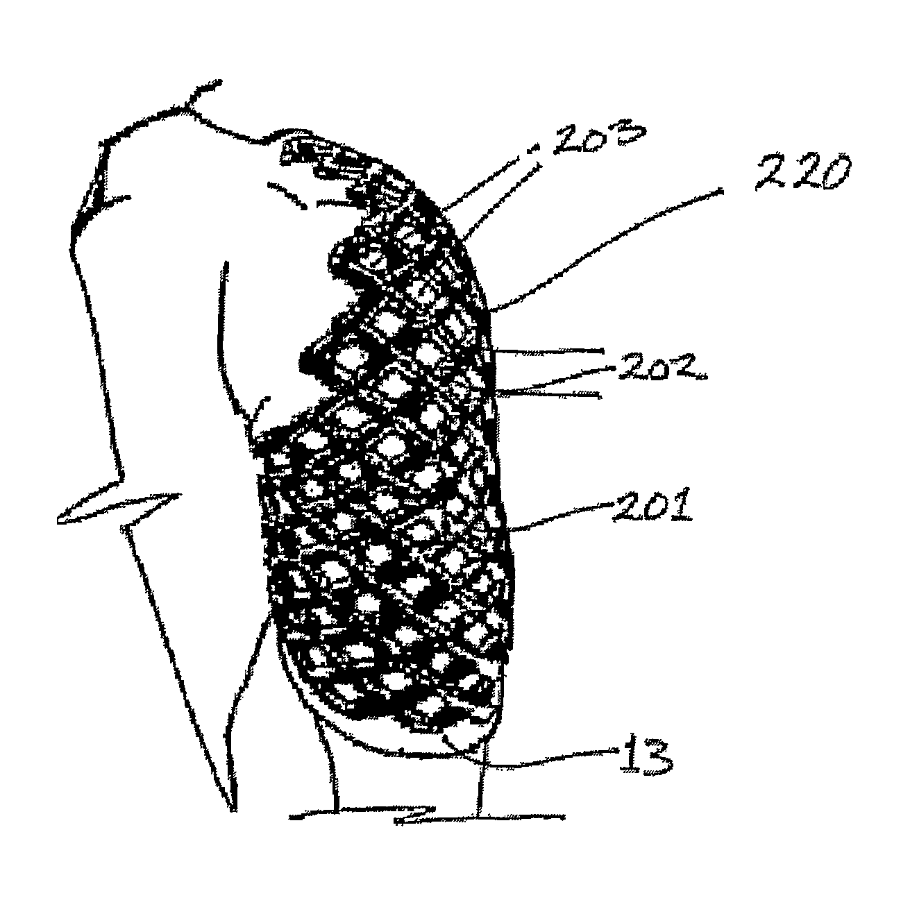 Geometrically apertured protective and/or splint device comprising a re-mouldable thermoplastic material