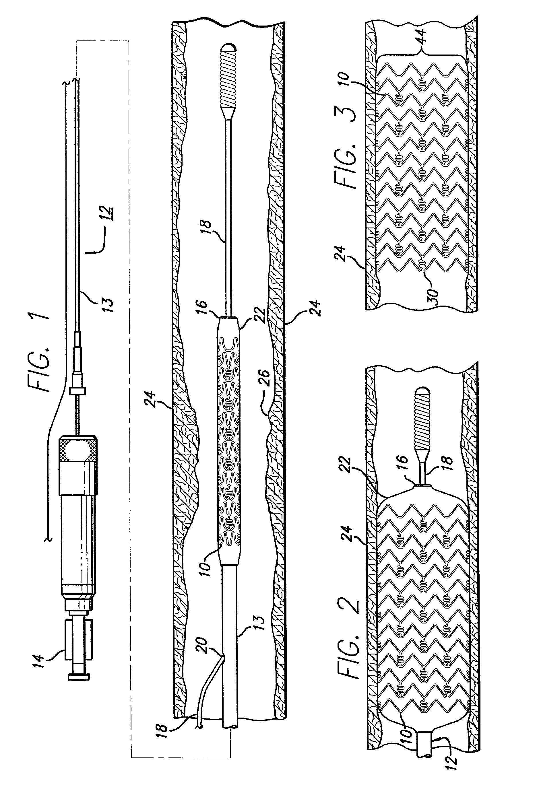 Hybrid stent and method of making