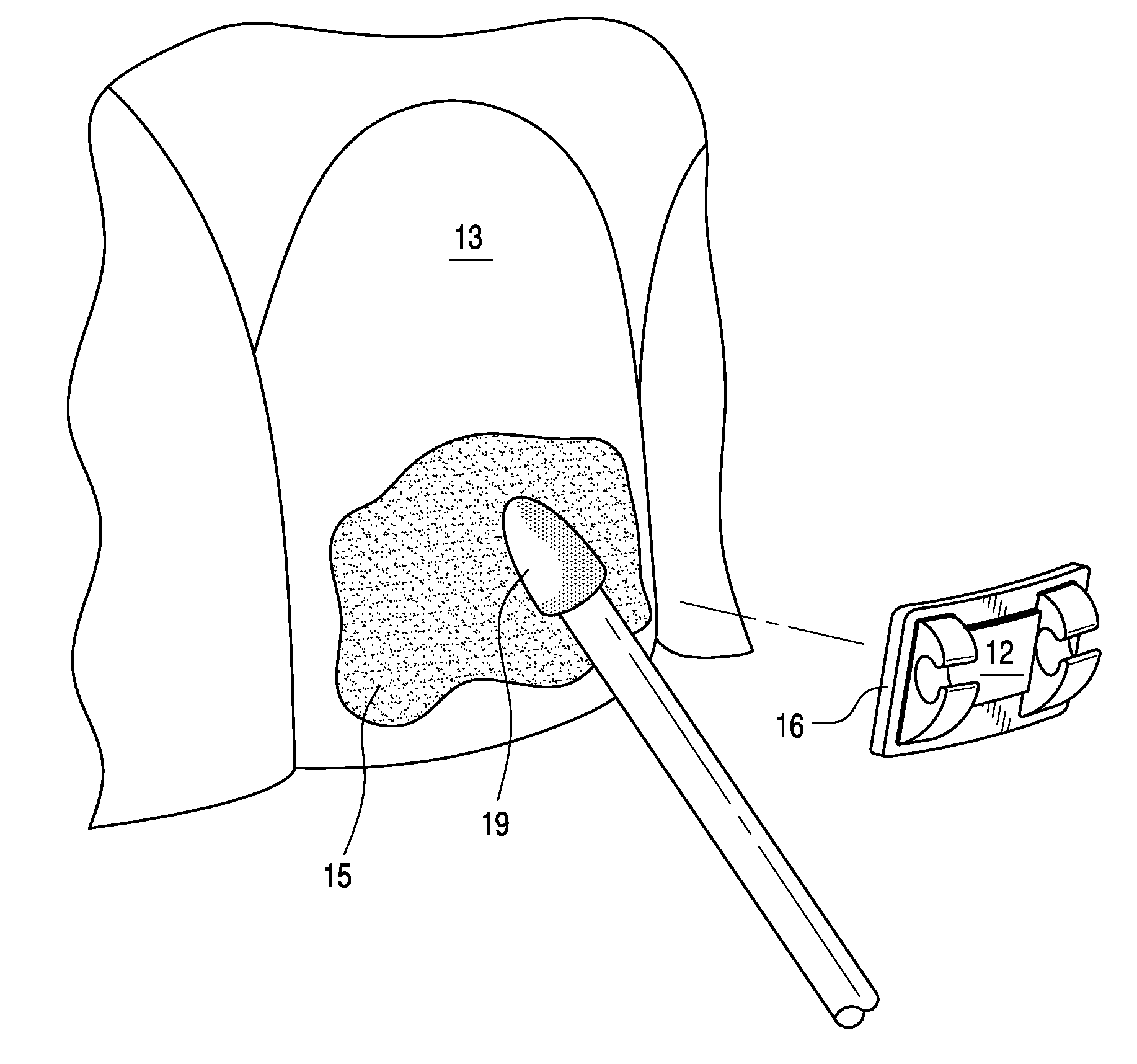 Adjustable orthodontic bracket and method