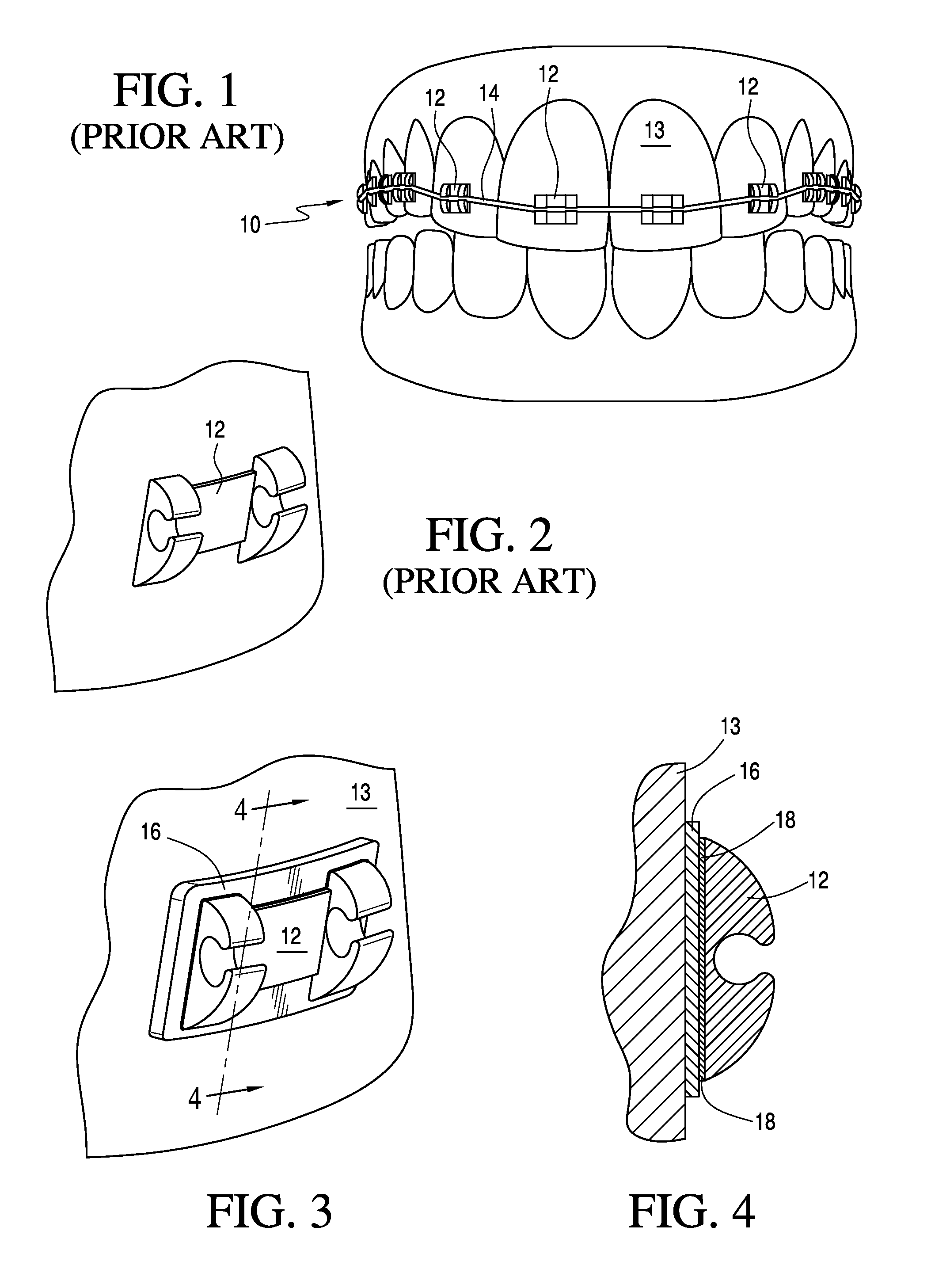 Adjustable orthodontic bracket and method