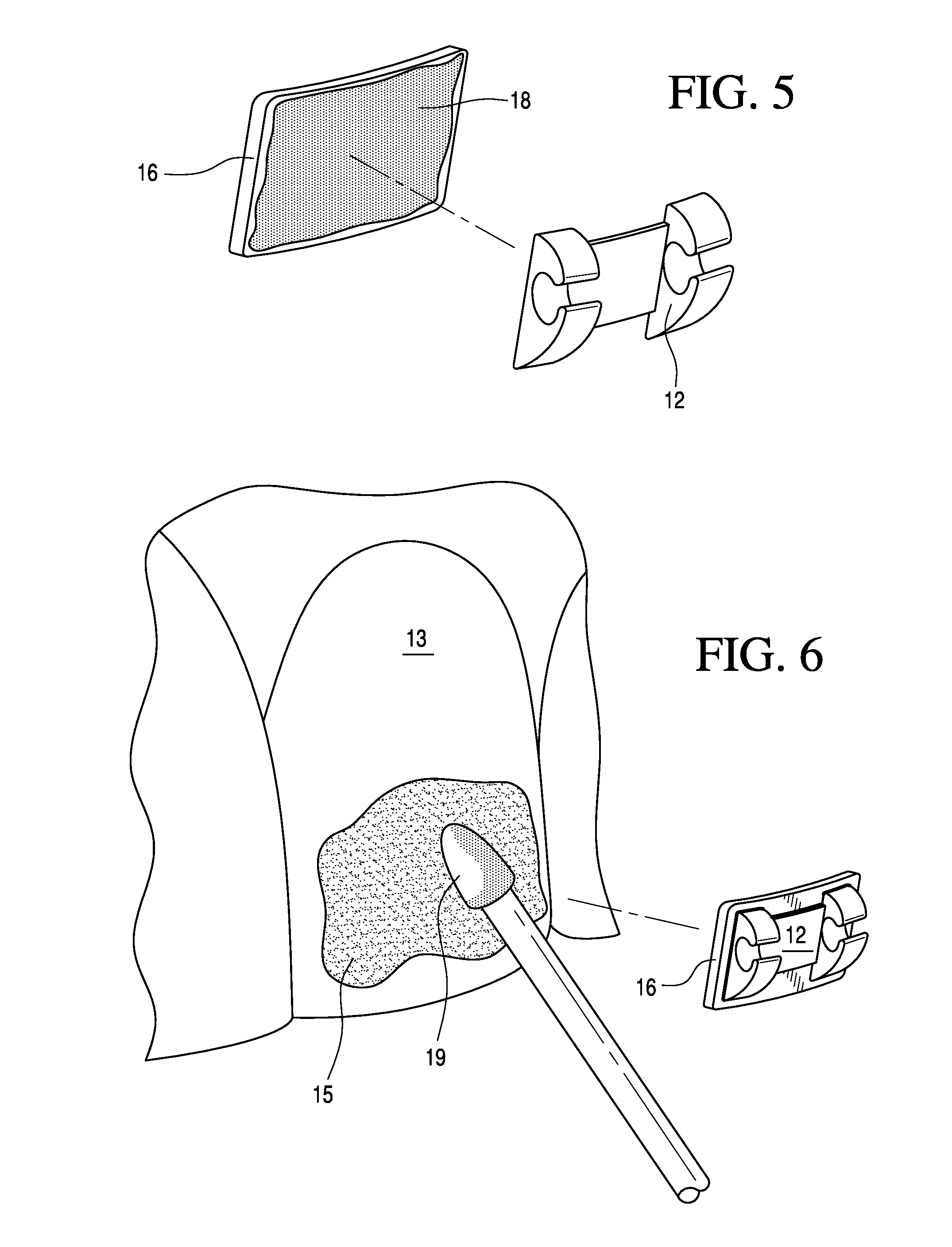 Adjustable orthodontic bracket and method