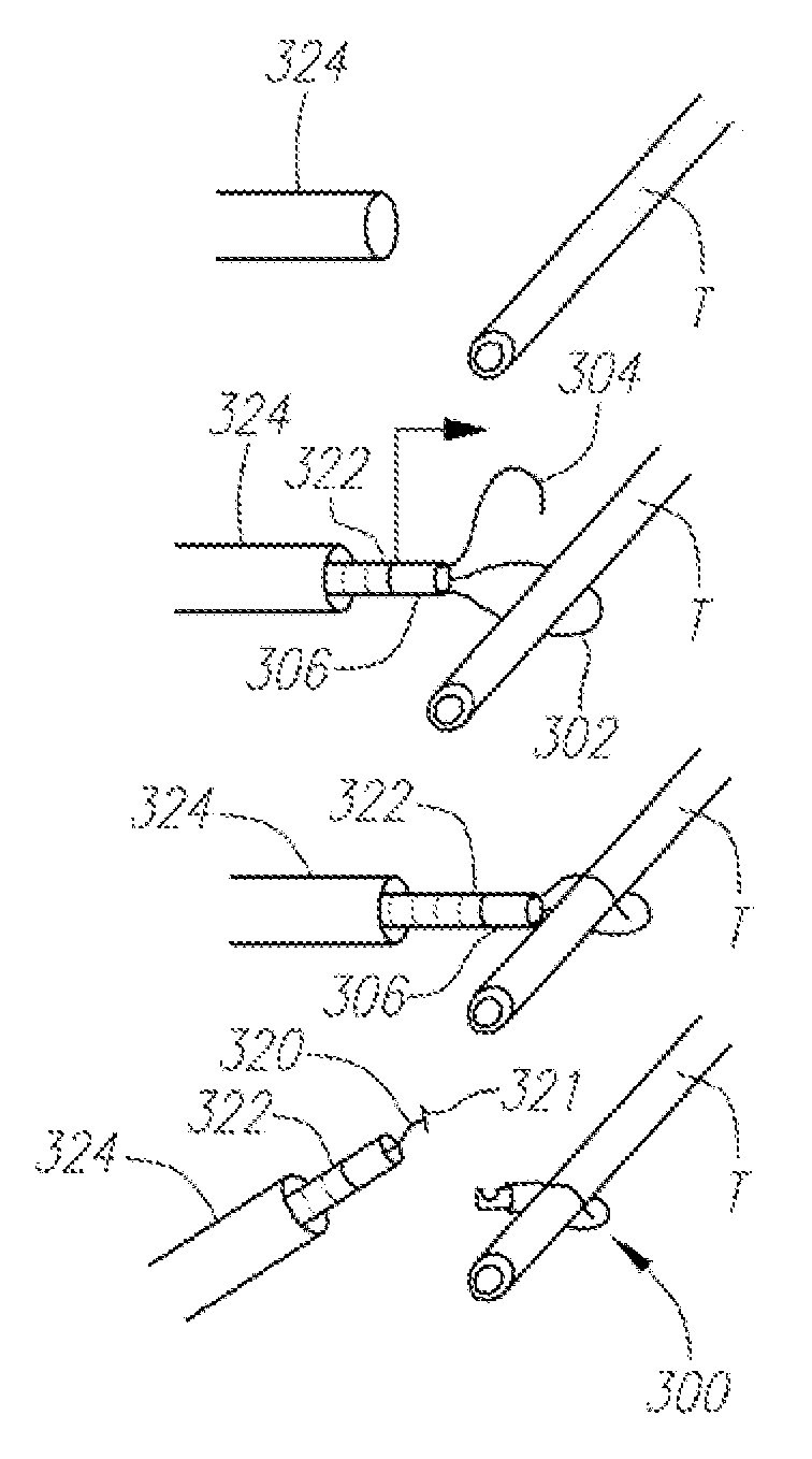 Endoscopic ligation