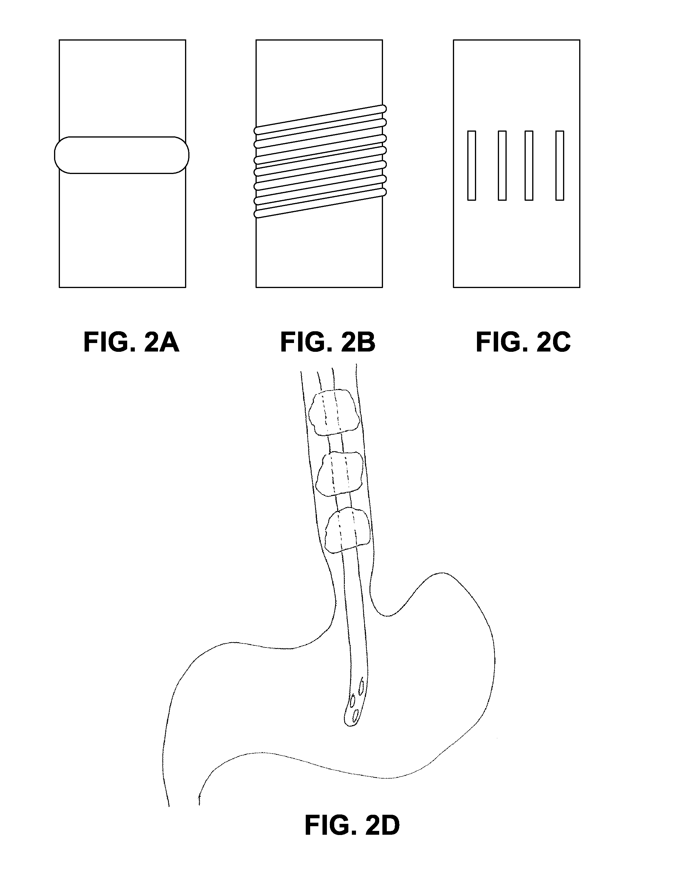 Method and device of detecting and/or blocking reflux